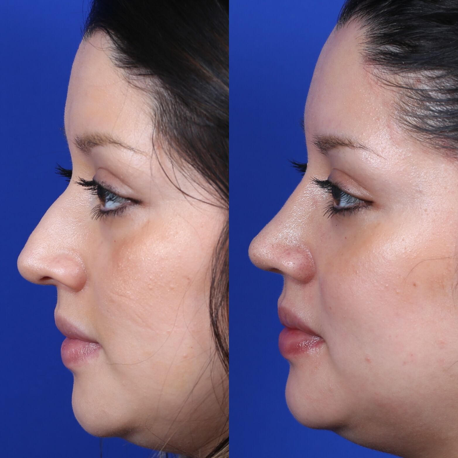 Right lateral profile comparison of female patient in her 20s before and after primary rhinoplasty