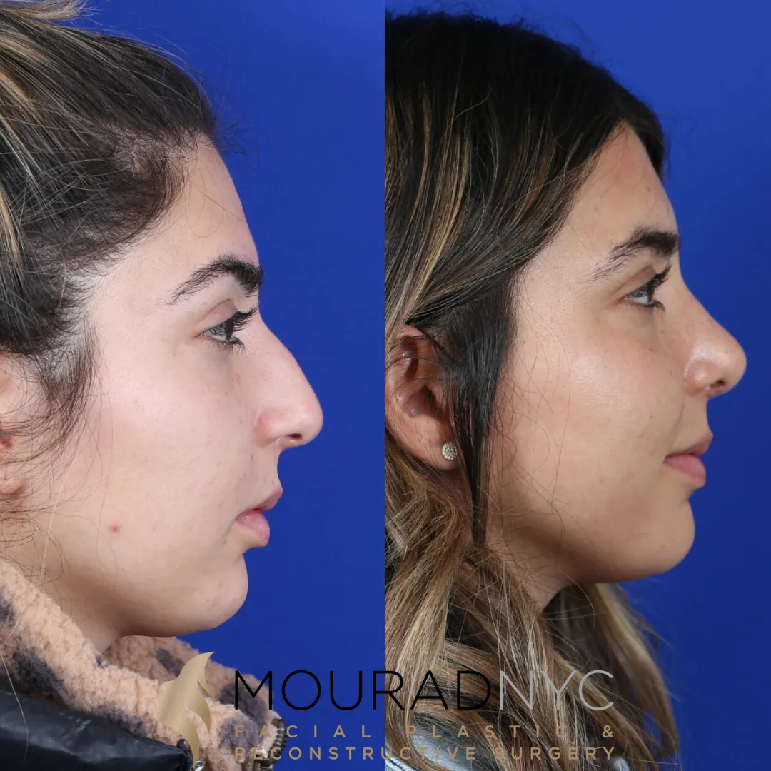 Left lateral profile comparison of female patient in her 20s before and after septorhinoplasty with rib graft and sinus surgery