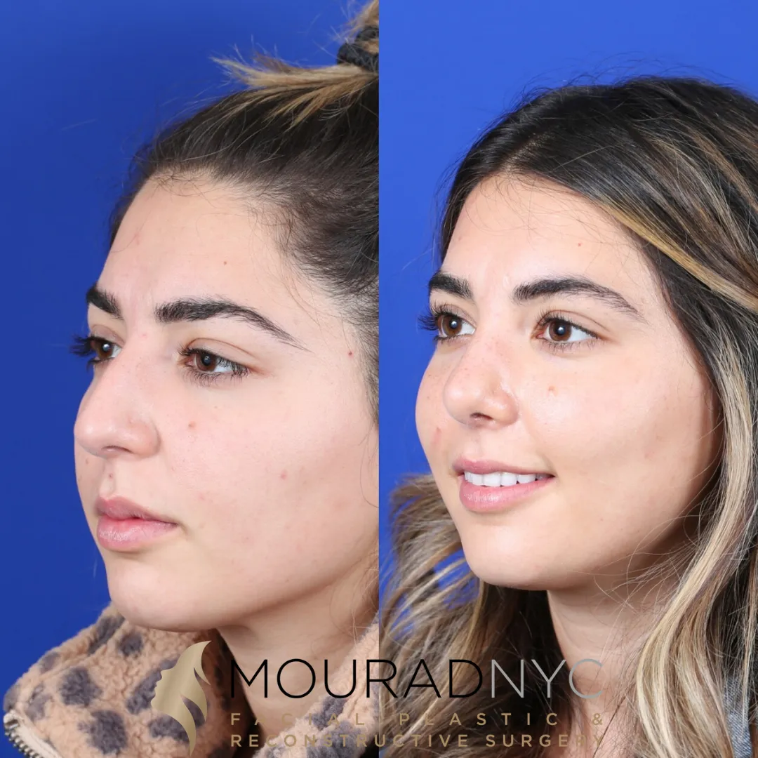 Right lateral profile comparison of female patient in her 20s before and after septorhinoplasty with rib graft and sinus surgery