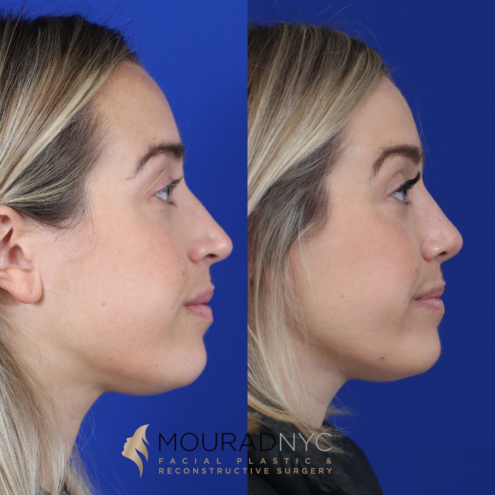 Left lateral profile comparison of female patient in her 30s before and after primary rhinoplasty
