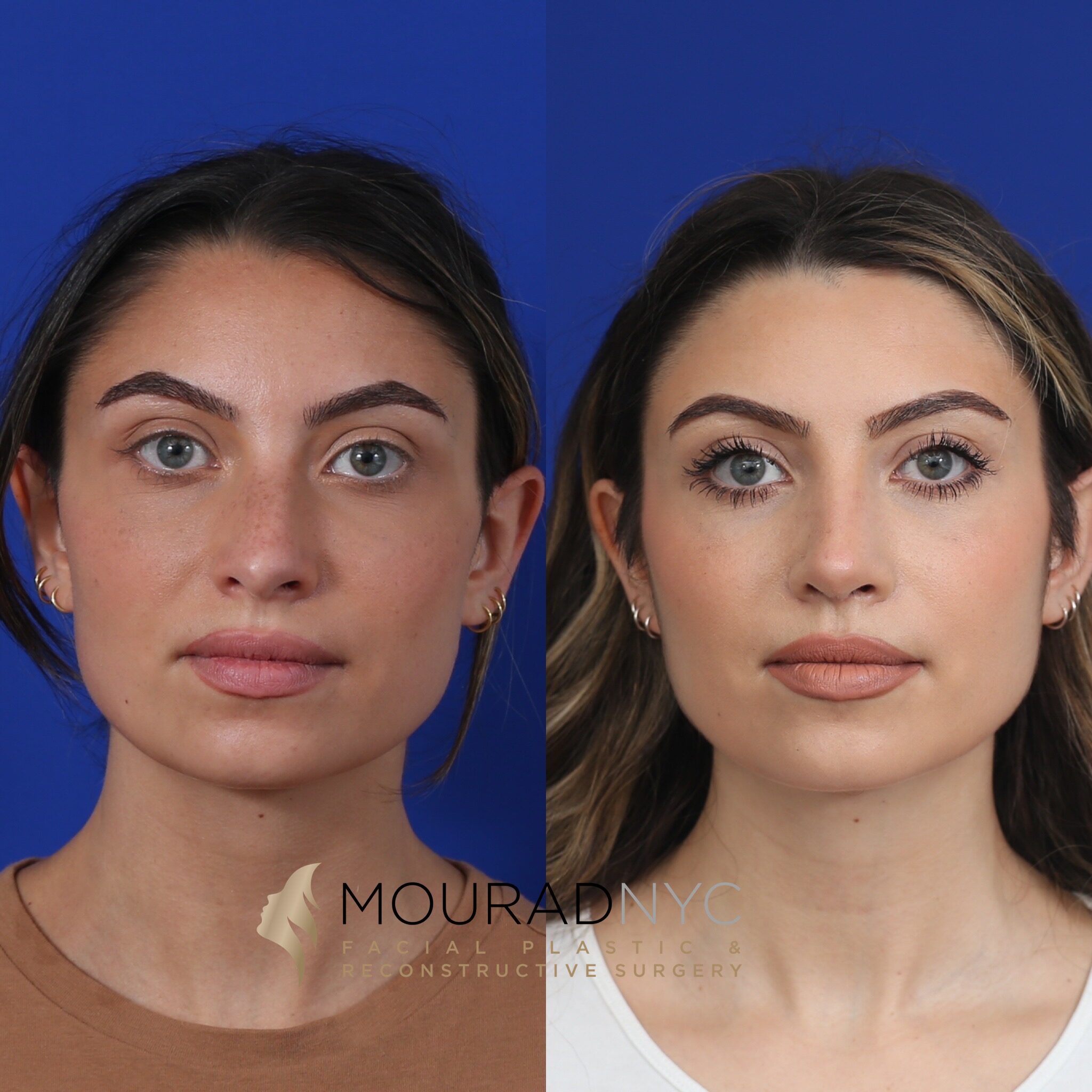 Frontal comparison before and after rhinoplasty
