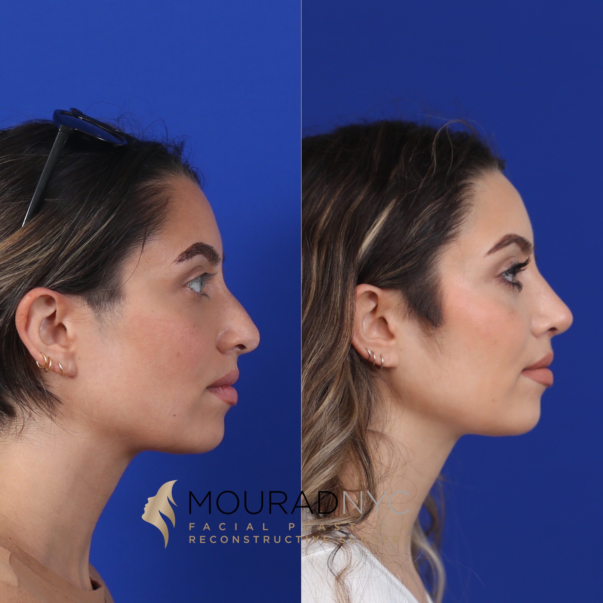 Left lateral profile comparison of female patient before and after primary rhinoplasty