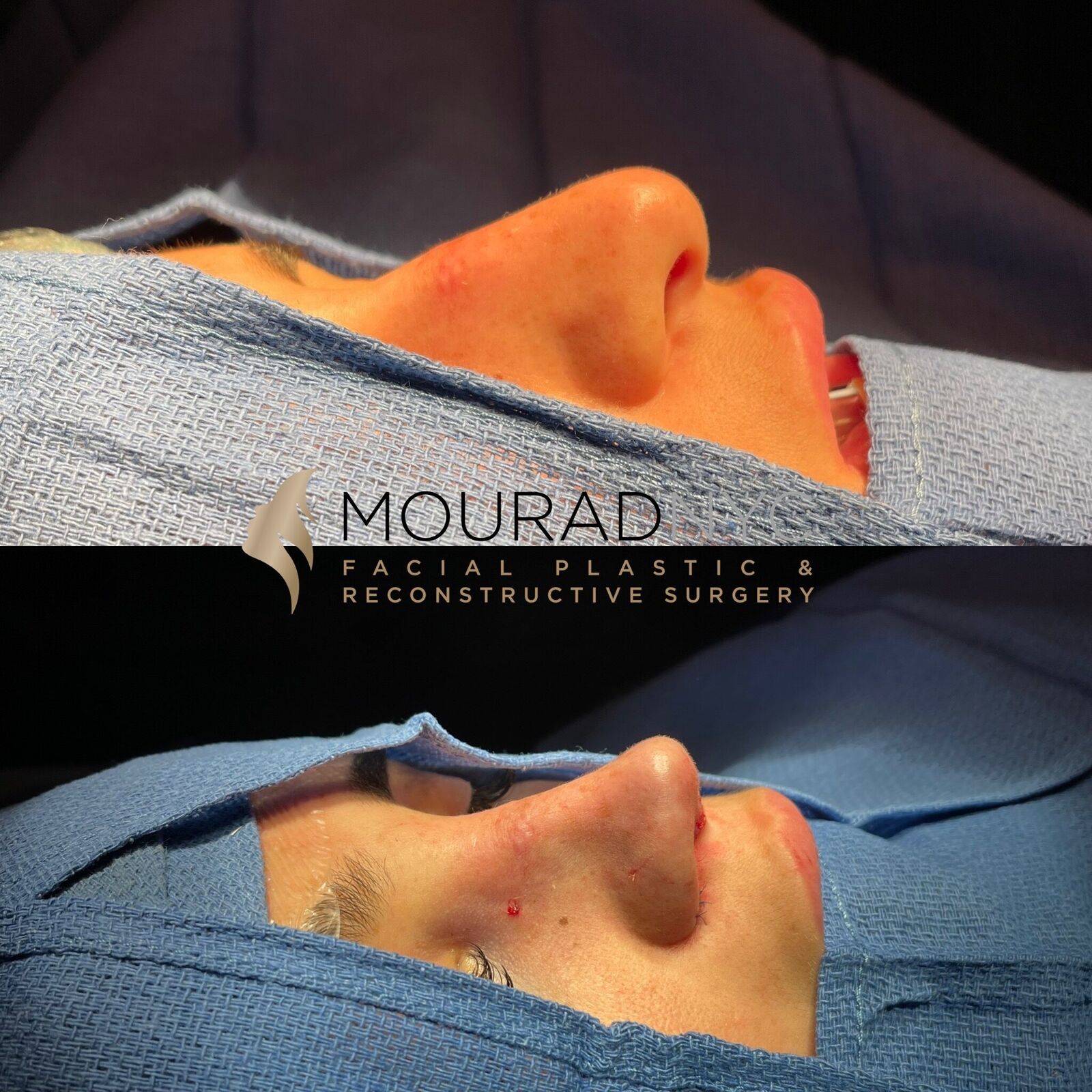 Intra-operative basal view of the nose during combined septorhinoplasty and sinus surgery showing tip and dorsum at two stages