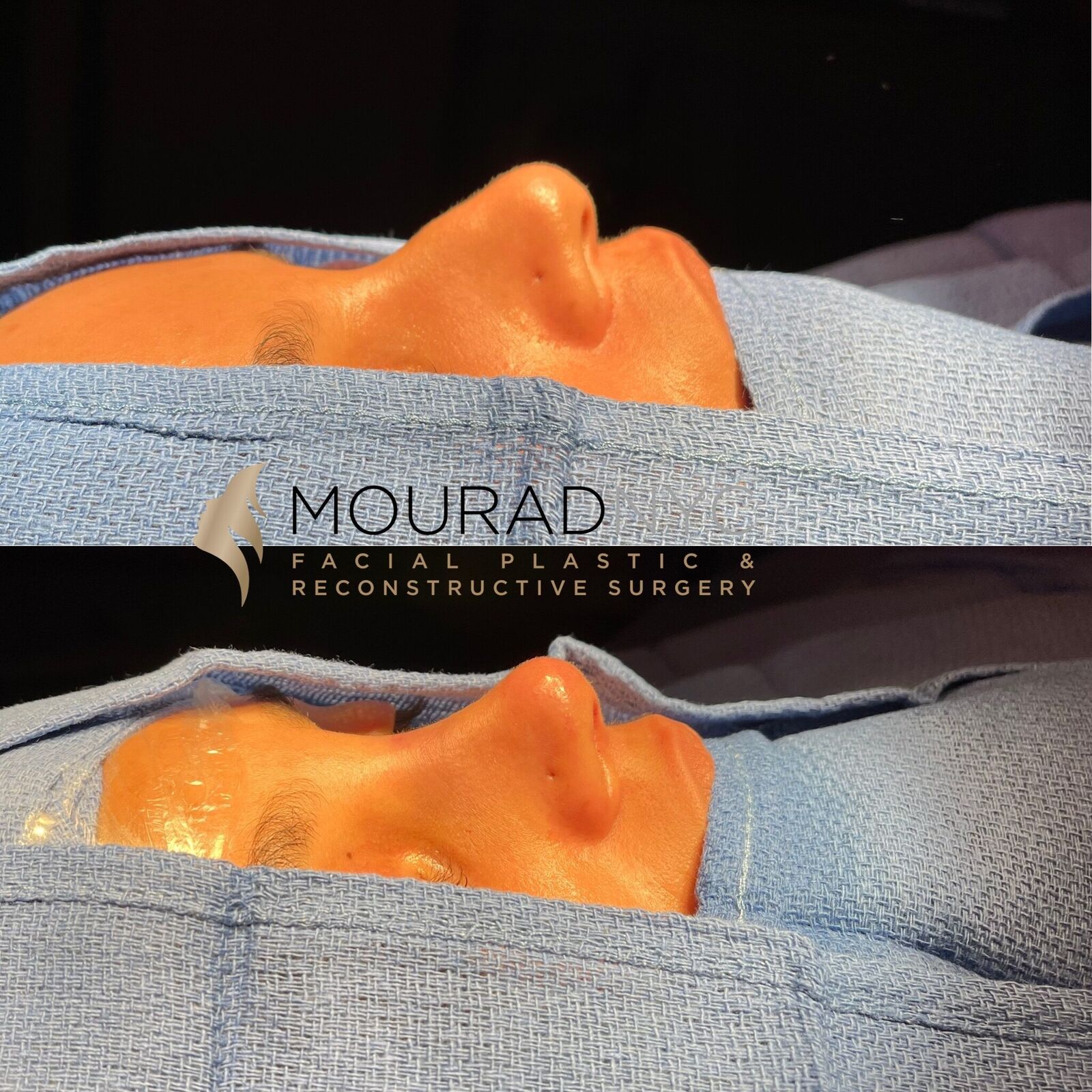 Intra-operative lateral view of the nose during closed rhinoplasty showing dorsal line and tip projection at two stages