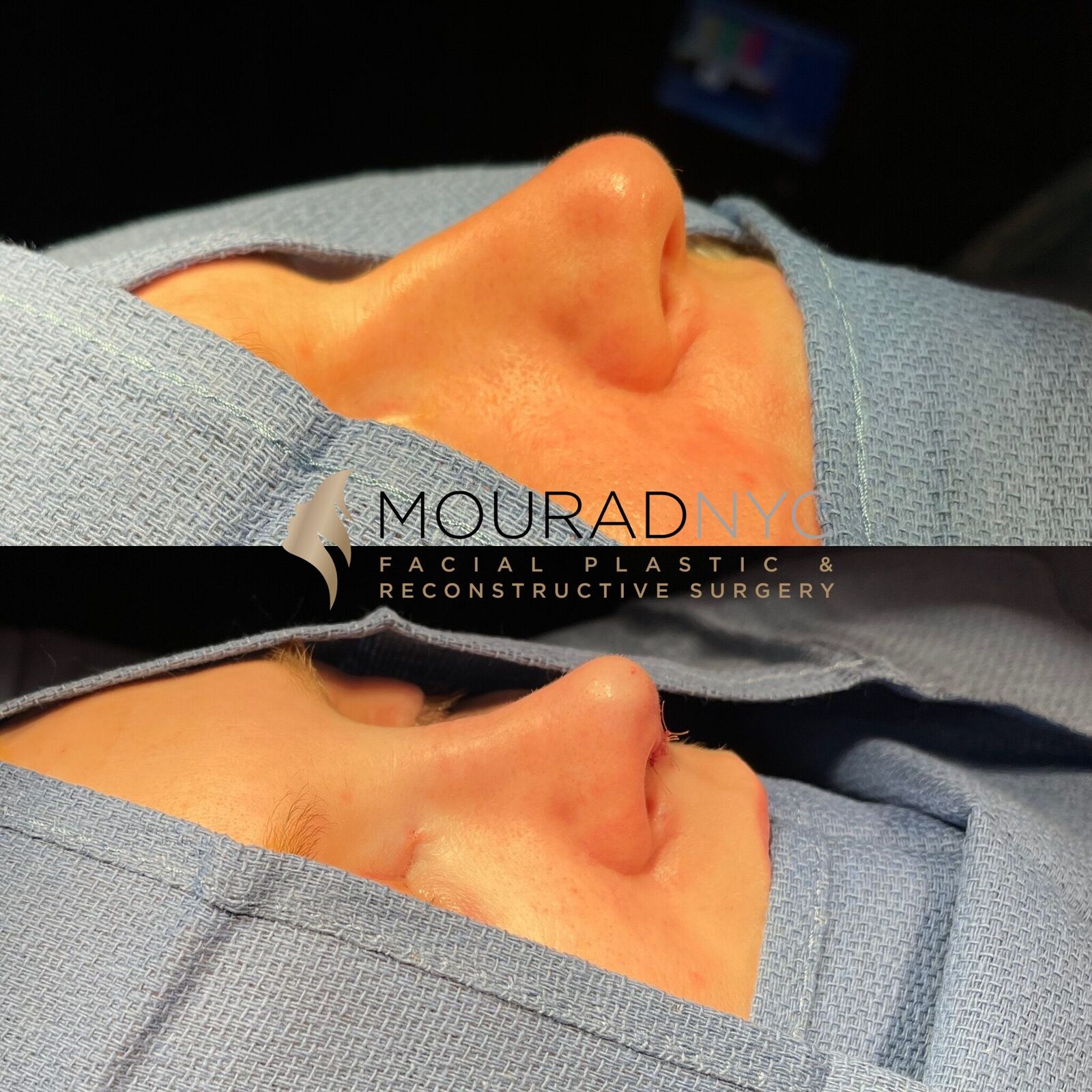Intra-operative basal view of the nose during primary rhinoplasty showing dorsal contour and tip at two stages