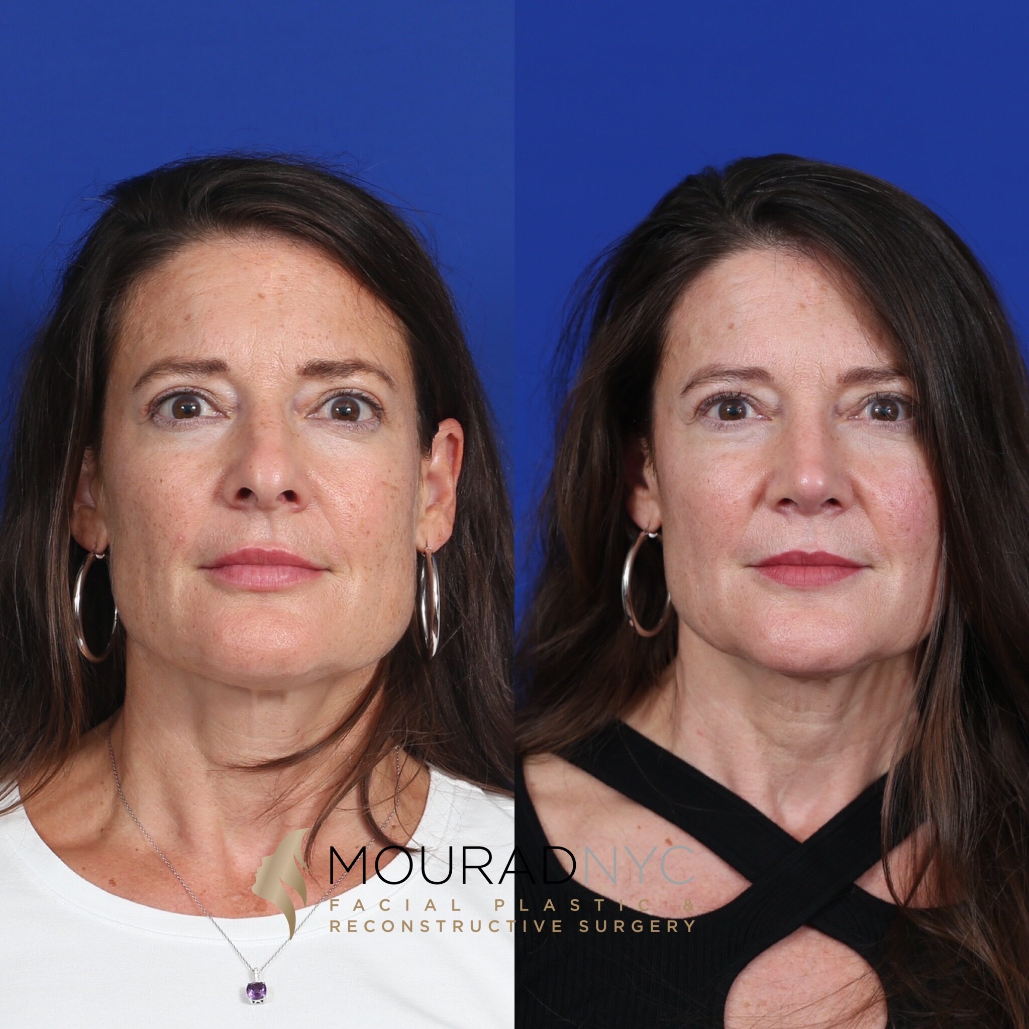 Frontal comparison before and after primary rhinoplasty