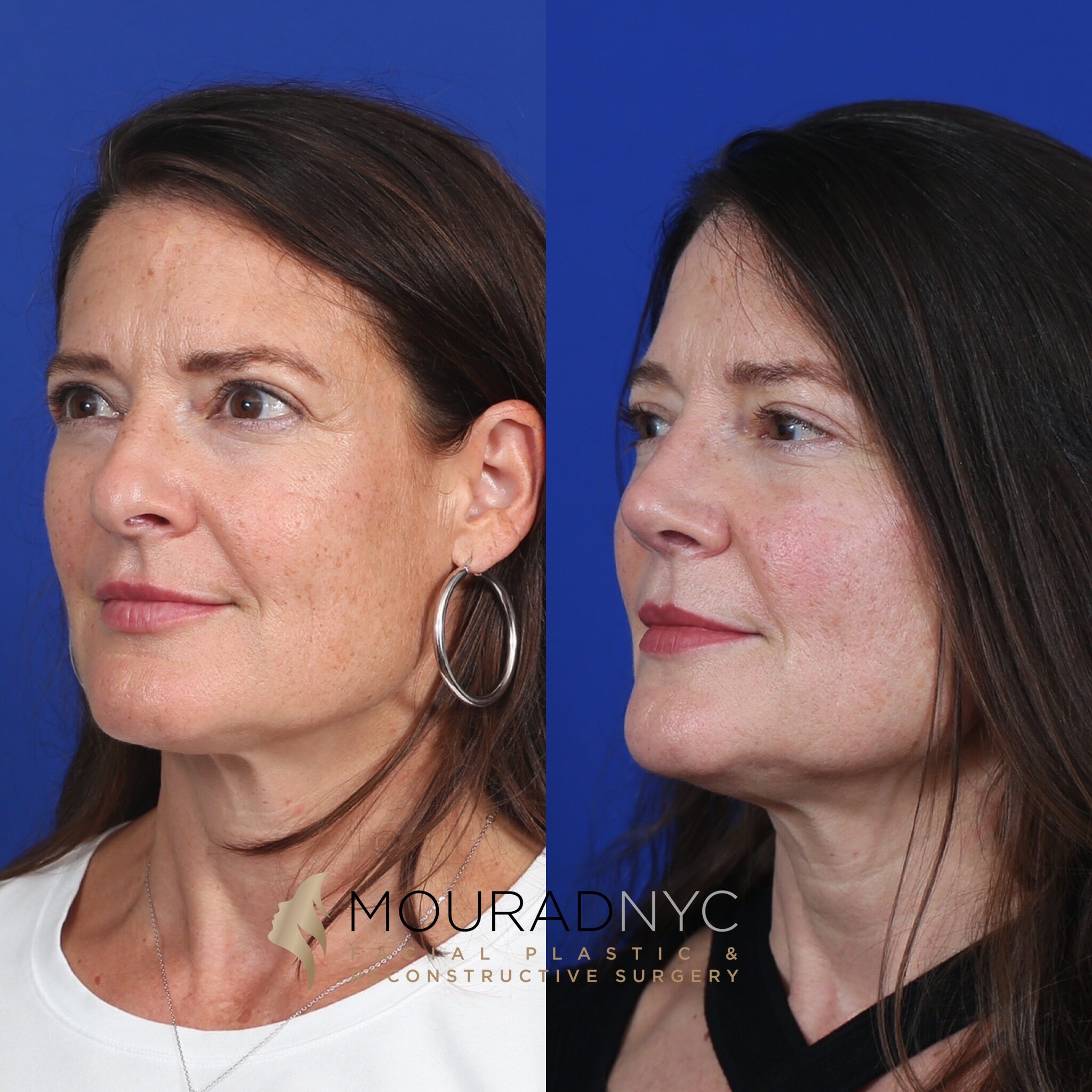 Right three-quarter comparison before and after primary rhinoplasty