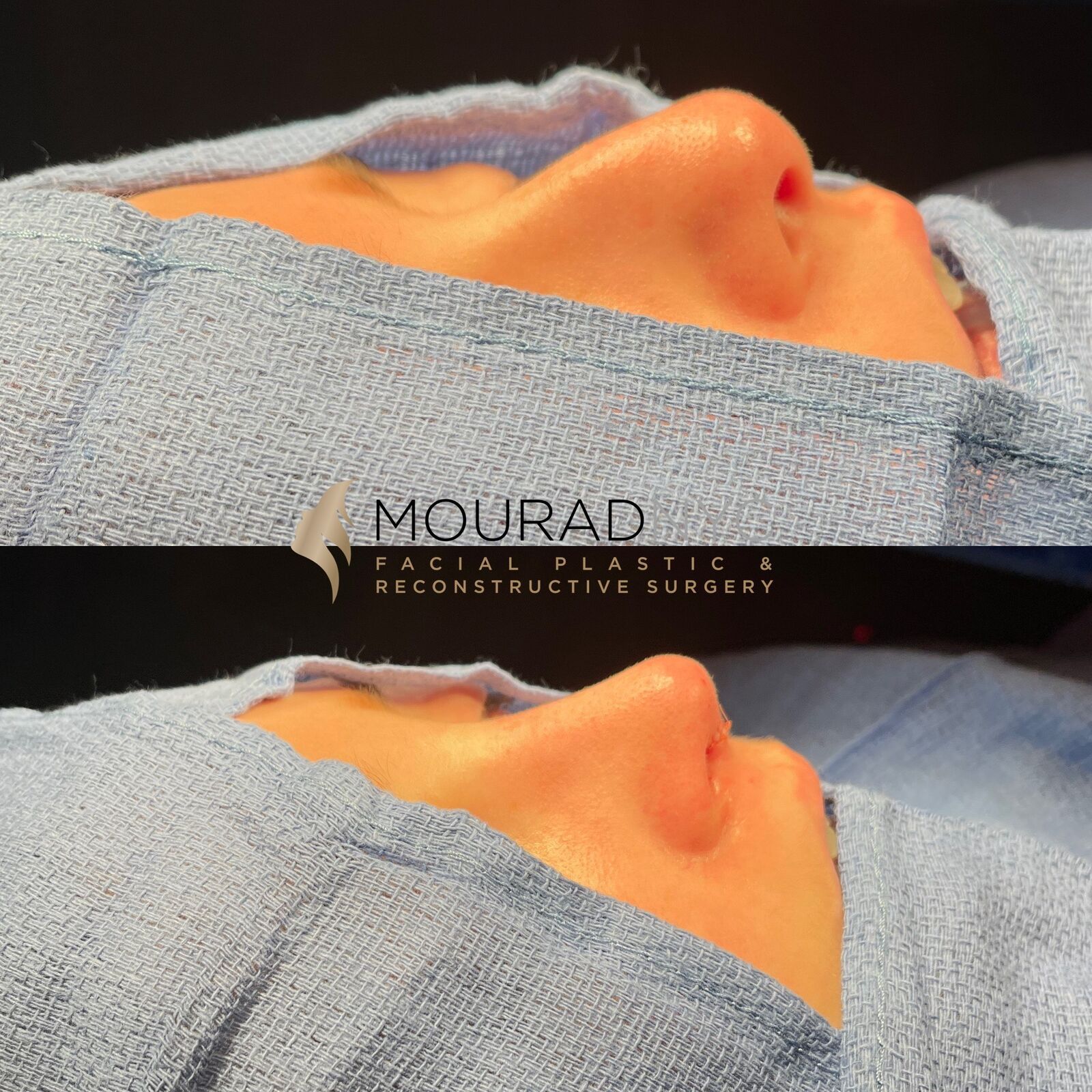 Intra-operative basal view of the nose during primary rhinoplasty showing tip and nostril contour at two stages