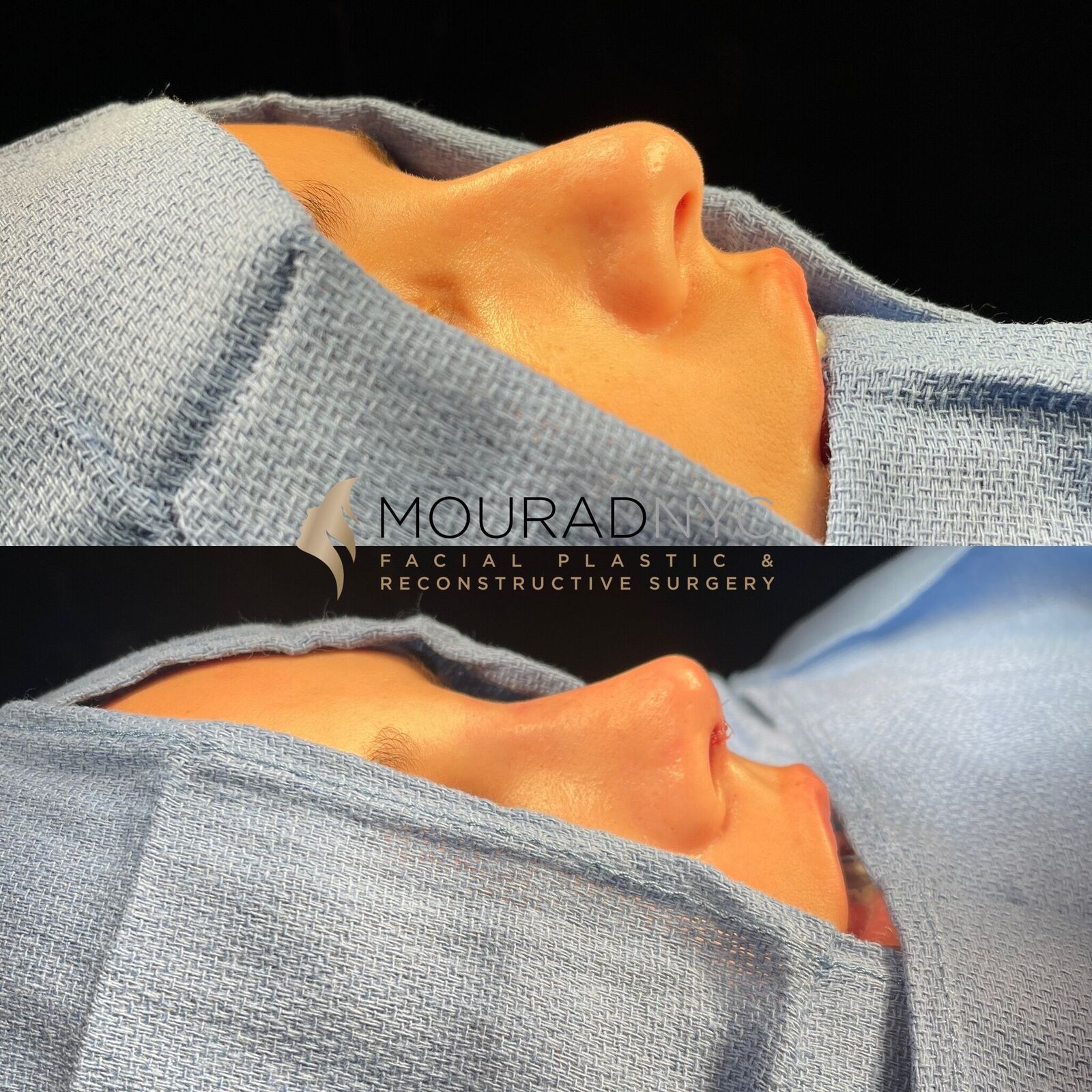 Intra-operative basal view of the nose during primary rhinoplasty showing tip definition and dorsal line at two stages