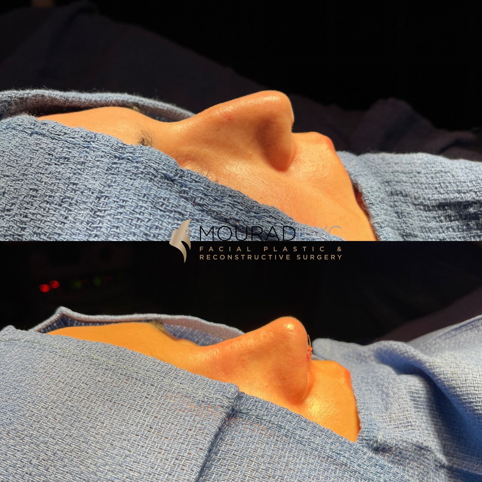 Intra-operative basal view of the nose during primary rhinoplasty showing dorsum and tip at two stages