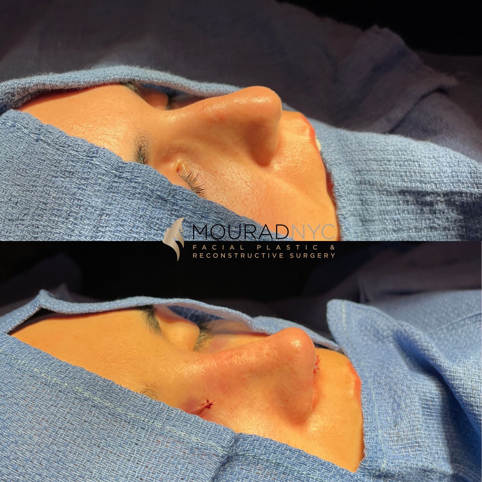 Intra-operative basal view of the nose during primary rhinoplasty showing dorsal hump reduction and tip refinement at two stages