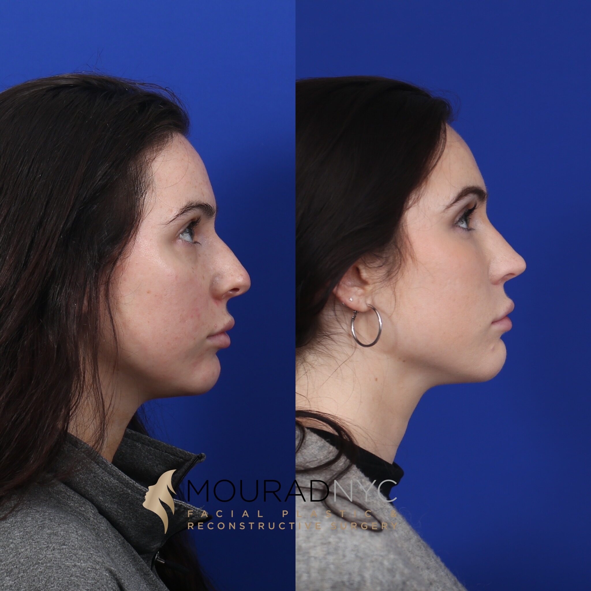 Left lateral profile comparison of female patient in her 20s before and after primary rhinoplasty