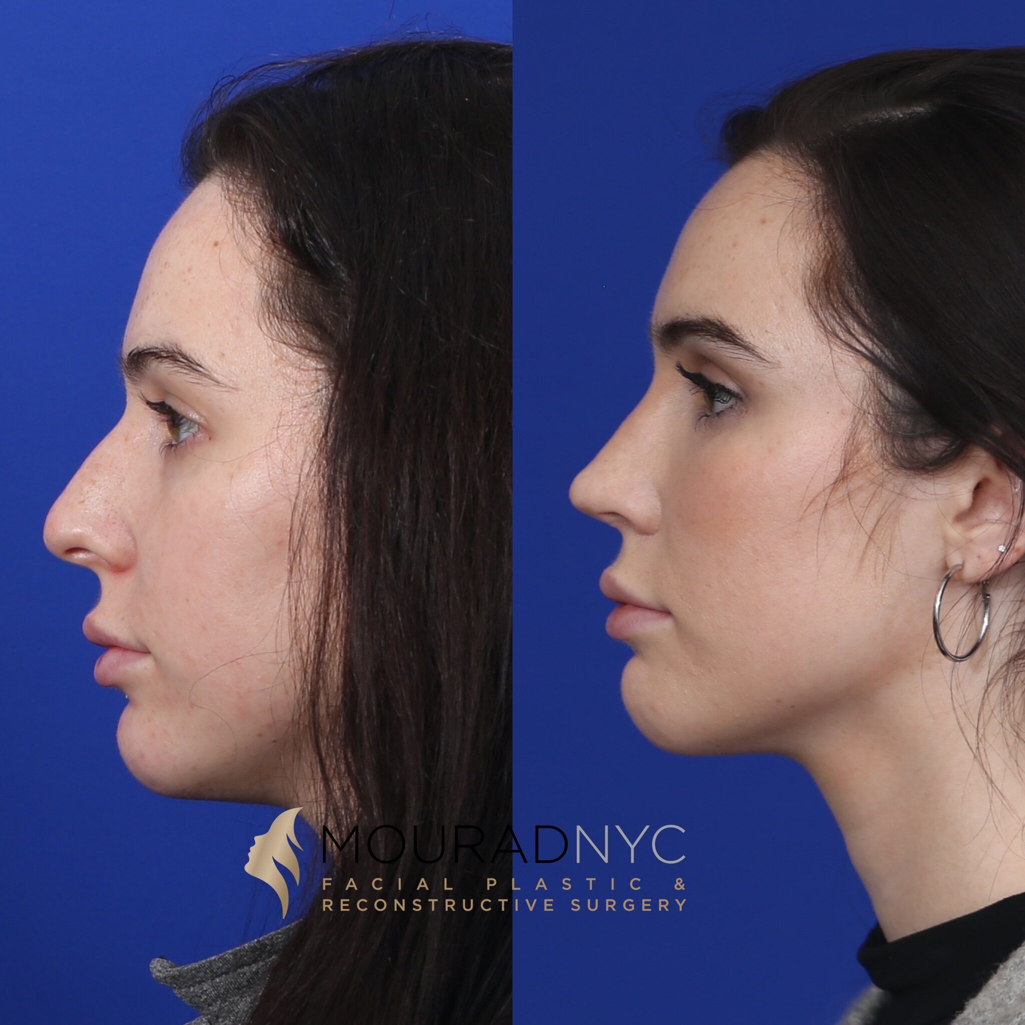 Right lateral profile comparison of female patient in her 20s before and after primary rhinoplasty