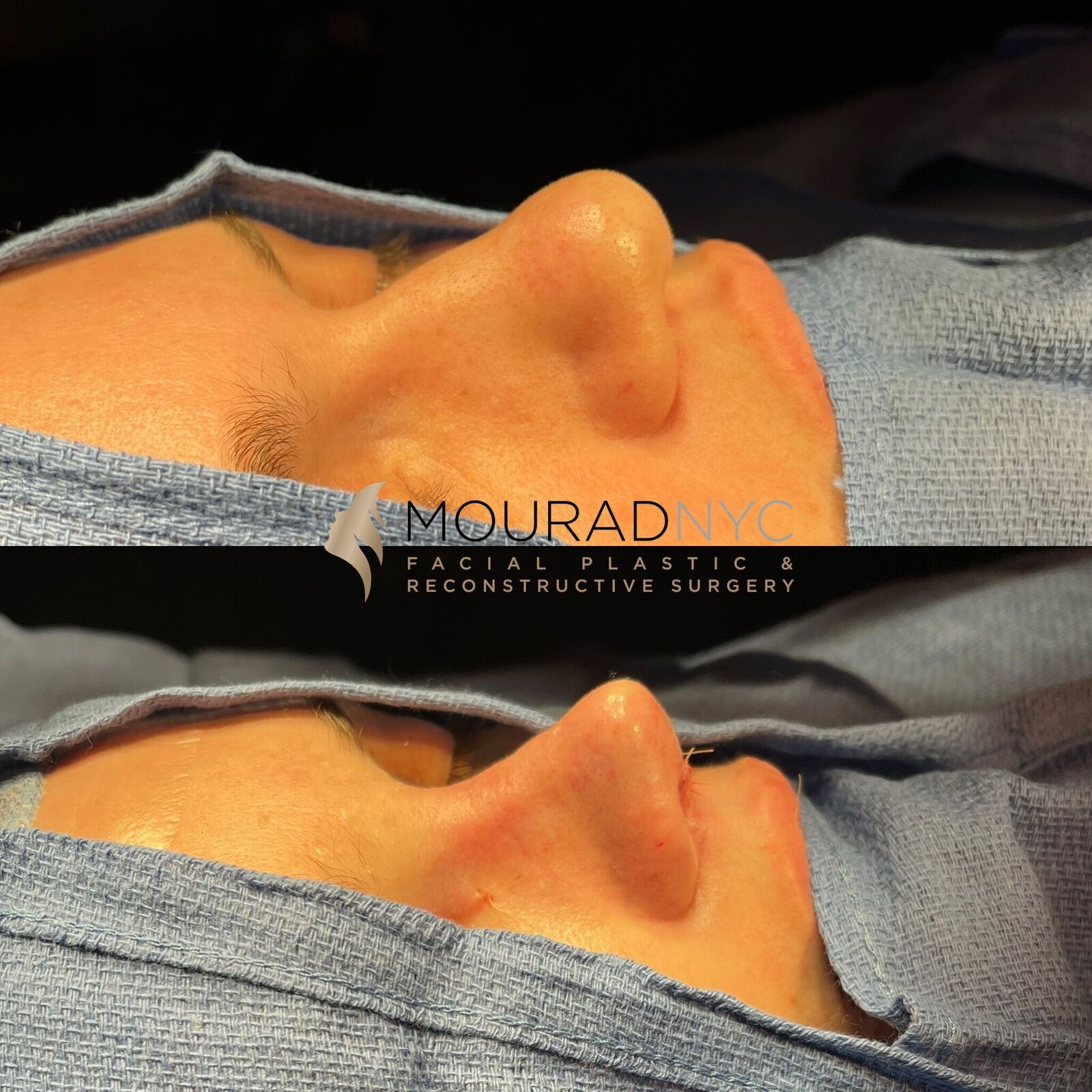 Intra-operative basal view of the nose during primary rhinoplasty showing dorsal hump reduction and tip refinement at two stages