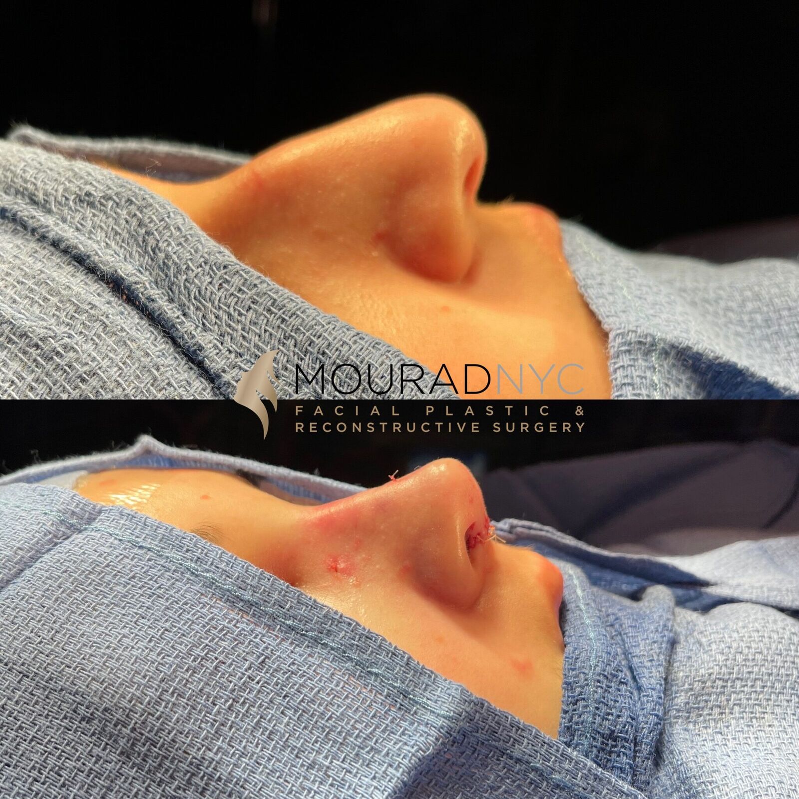 Intra-operative basal view of the nose during combined teenage rhinoplasty and sinus surgery showing tip and dorsum at two stages