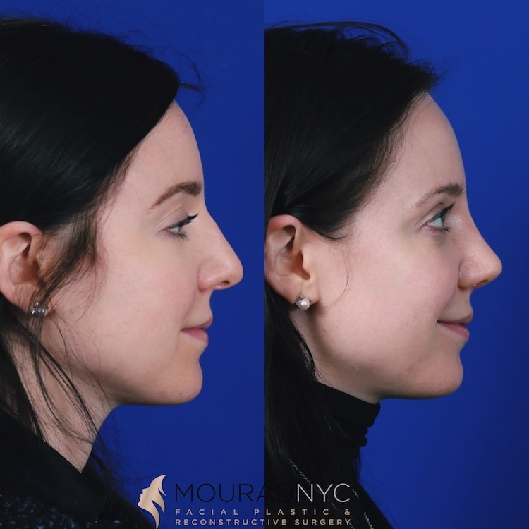 Left lateral profile comparison of female patient in her 20s before and after septorhinoplasty with rib graft and broken nose repair
