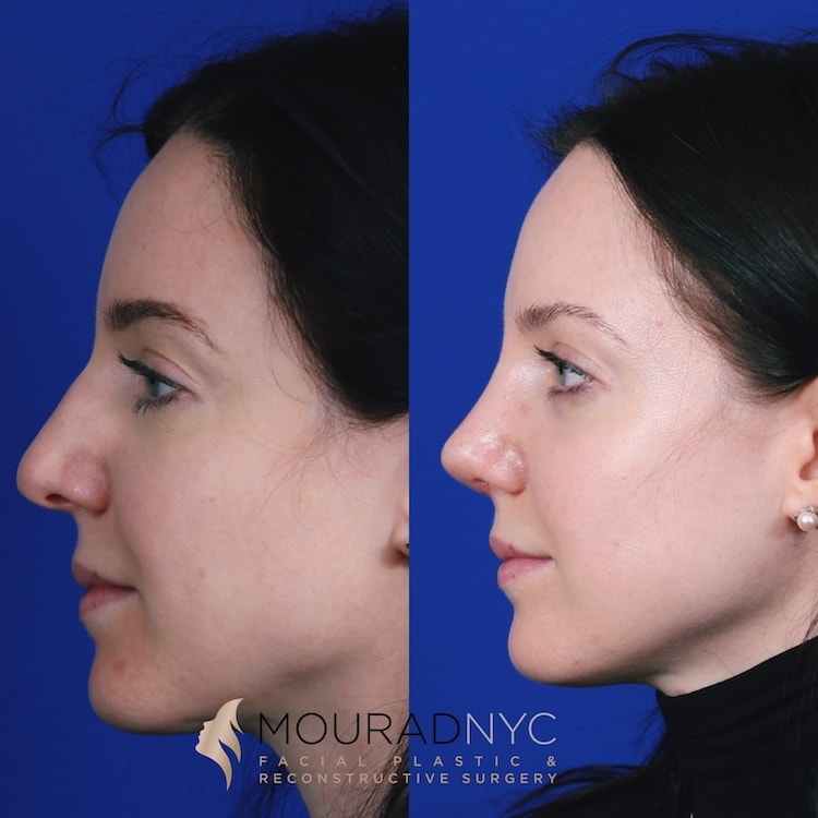Right lateral profile comparison of female patient in her 20s before and after septorhinoplasty with rib graft and broken nose repair