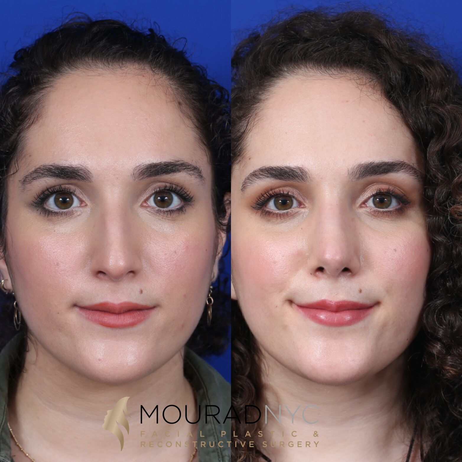 Frontal comparison of female patient in her 20s before and after septorhinoplasty with sinus surgery