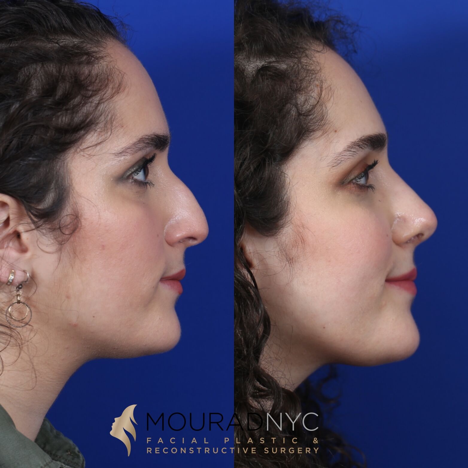 Left lateral profile comparison of female patient in her 20s before and after septorhinoplasty with sinus surgery