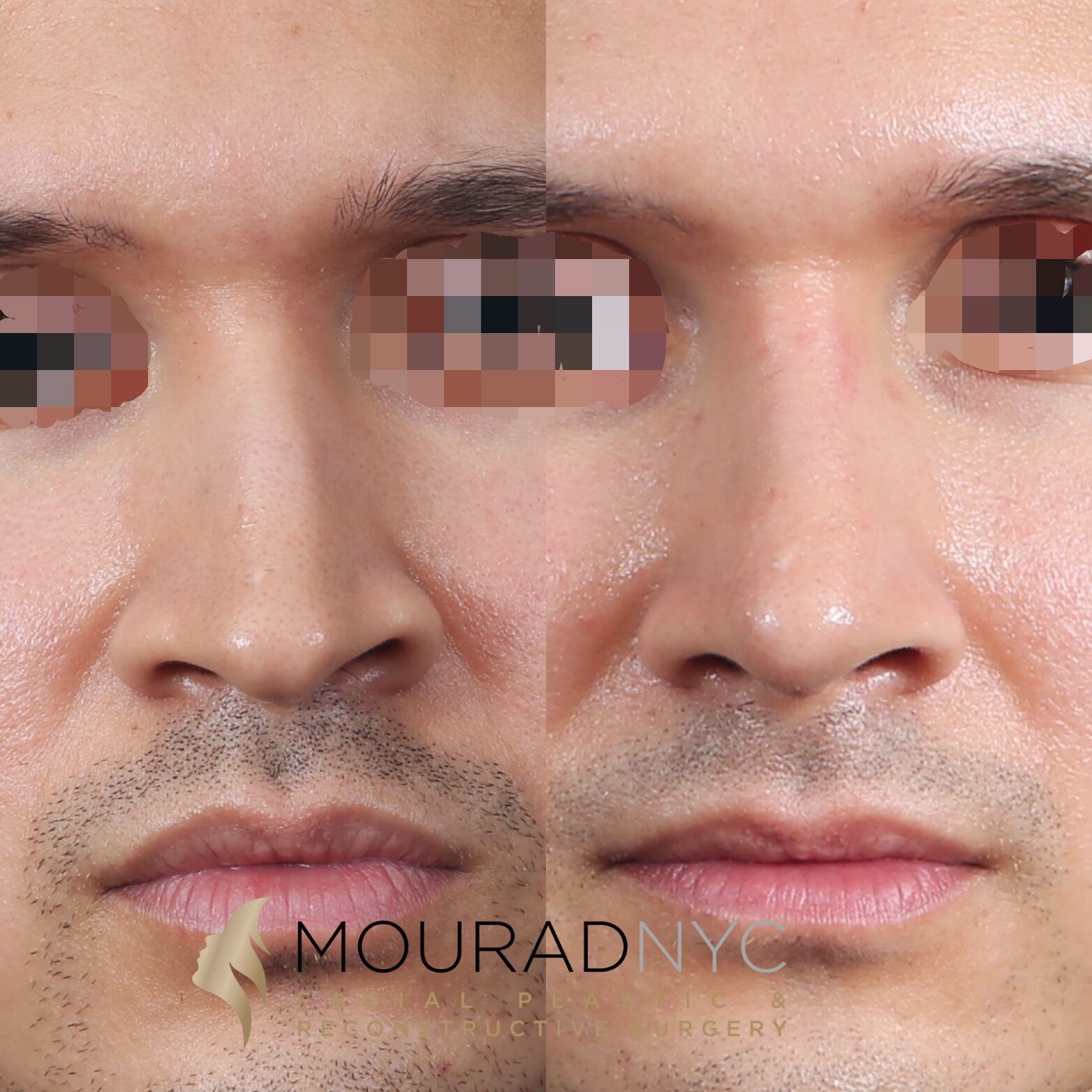 Frontal comparison of male patient in his 30s before and after revision rhinoplasty with rib graft