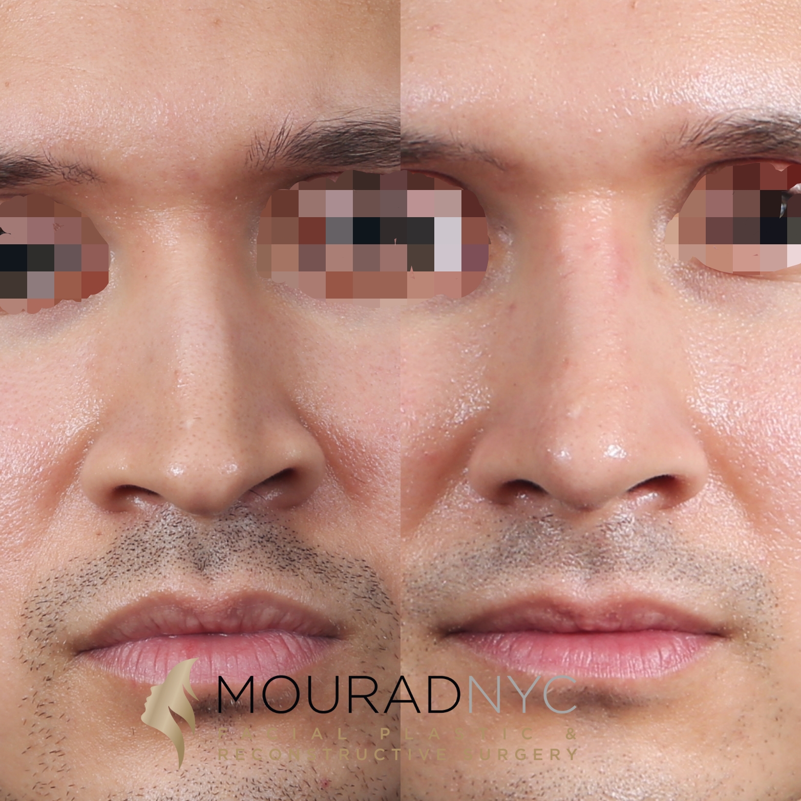 Frontal comparison of male patient in his 30s before and after revision rhinoplasty with rib graft