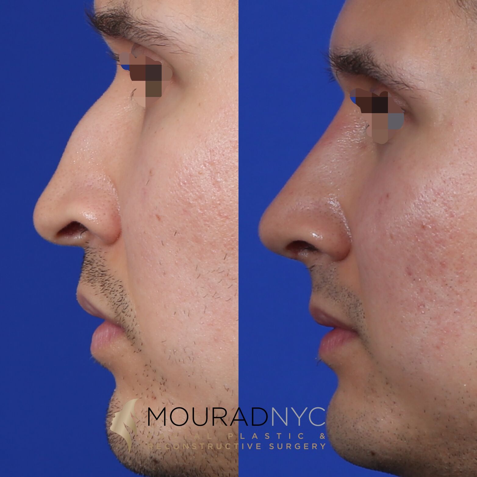 Left lateral profile comparison of male patient in his 30s before and after revision rhinoplasty with rib graft