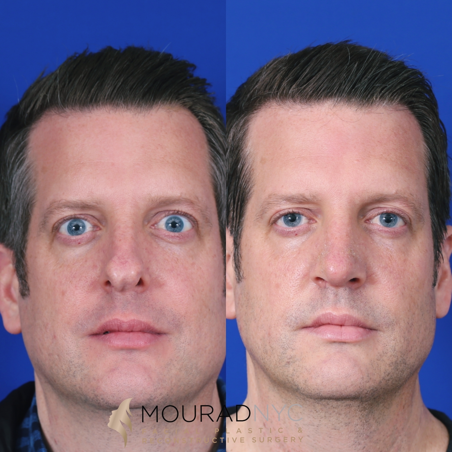 Frontal comparison of male patient in his 30s before and after revision rhinoplasty with septoplasty and sinus surgery