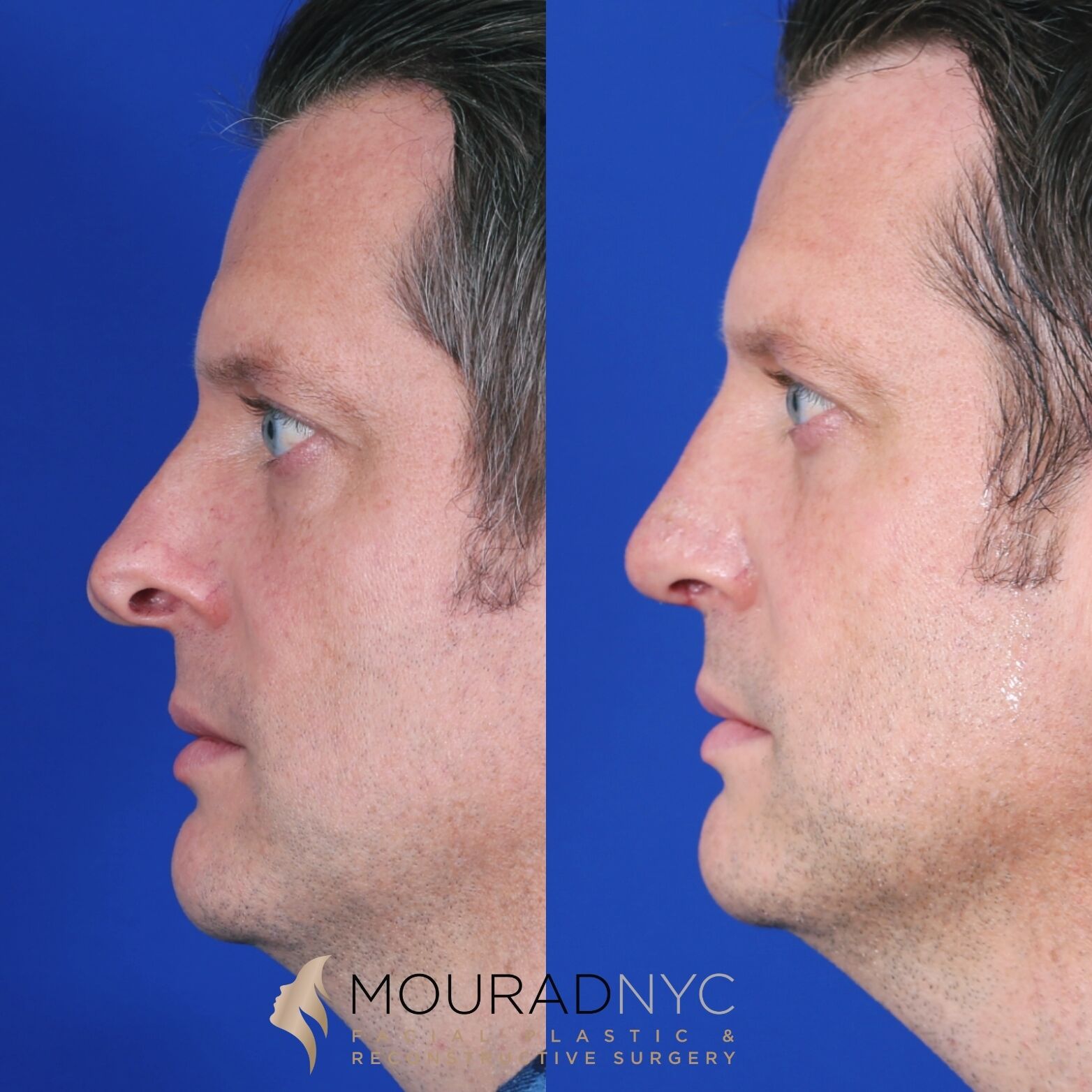 Right lateral profile comparison of male patient in his 30s before and after revision rhinoplasty with septoplasty and sinus surgery