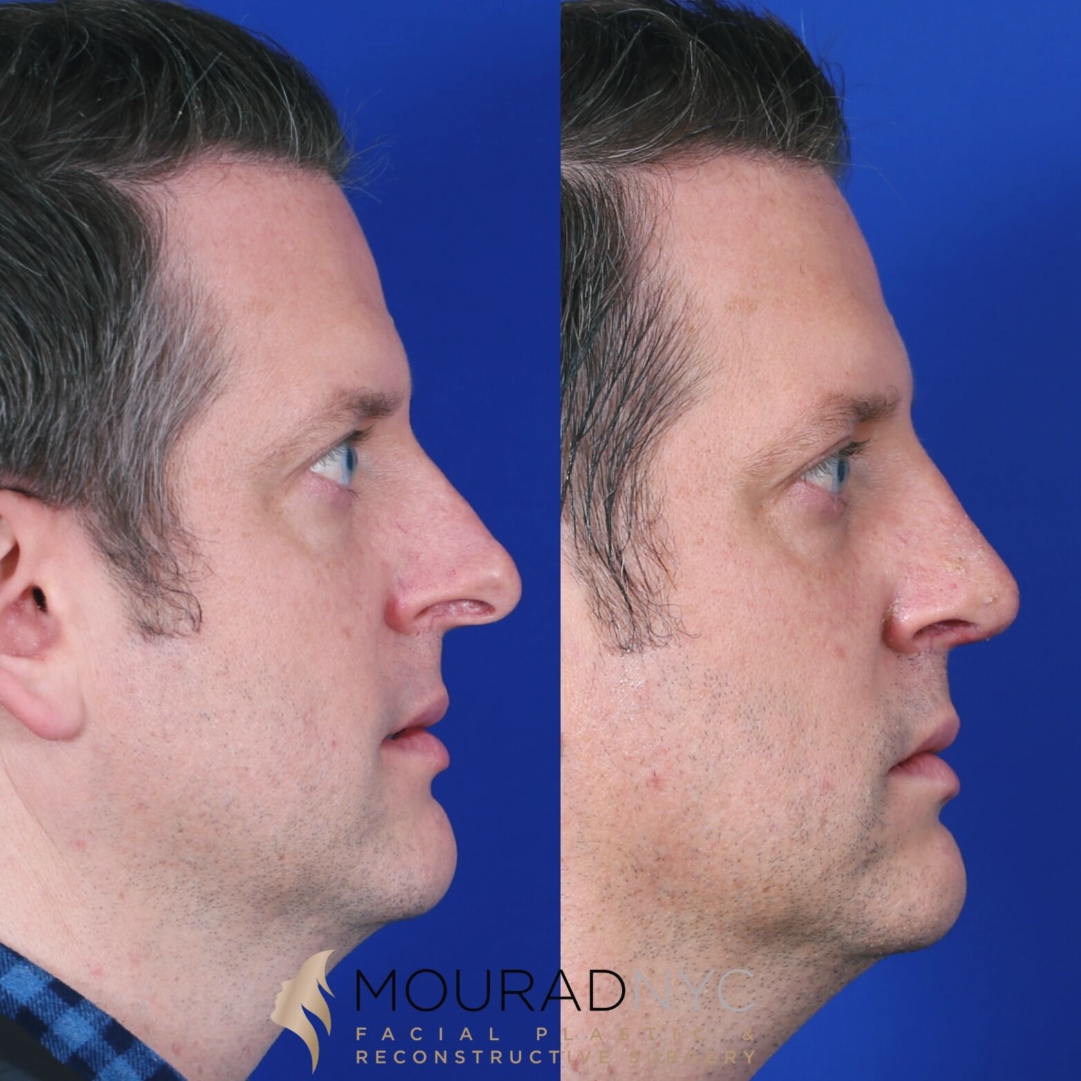 Left lateral profile comparison of male patient in his 30s before and after revision rhinoplasty with septoplasty and sinus surgery