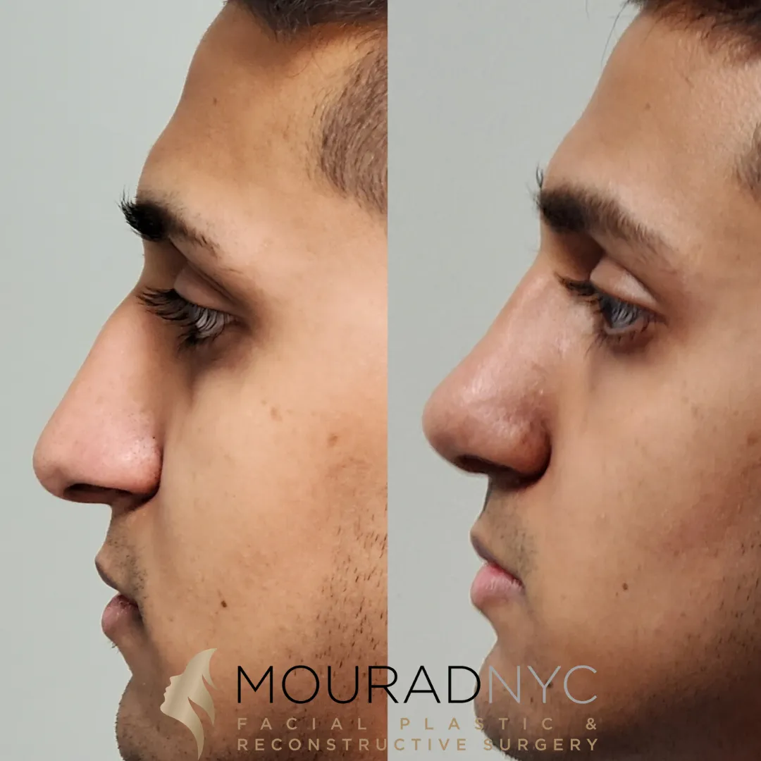 Right lateral profile comparison of male patient in his 20s before and after revision rhinoplasty with rib graft