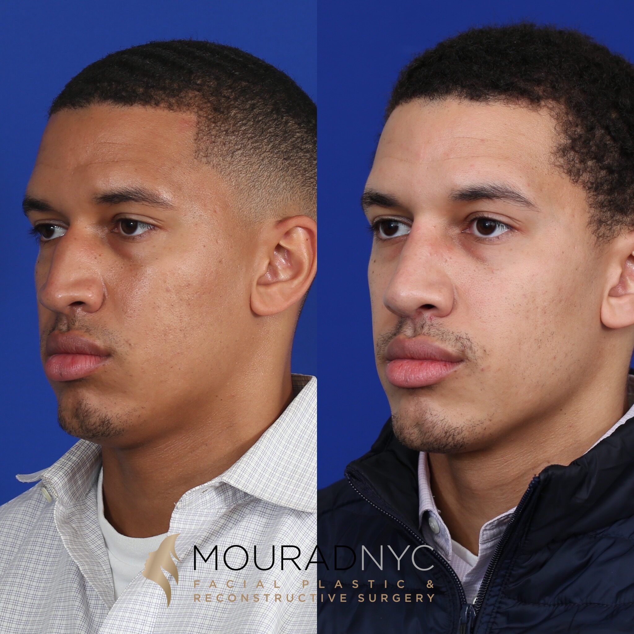 Right three-quarter comparison before and after ethnic rhinoplasty