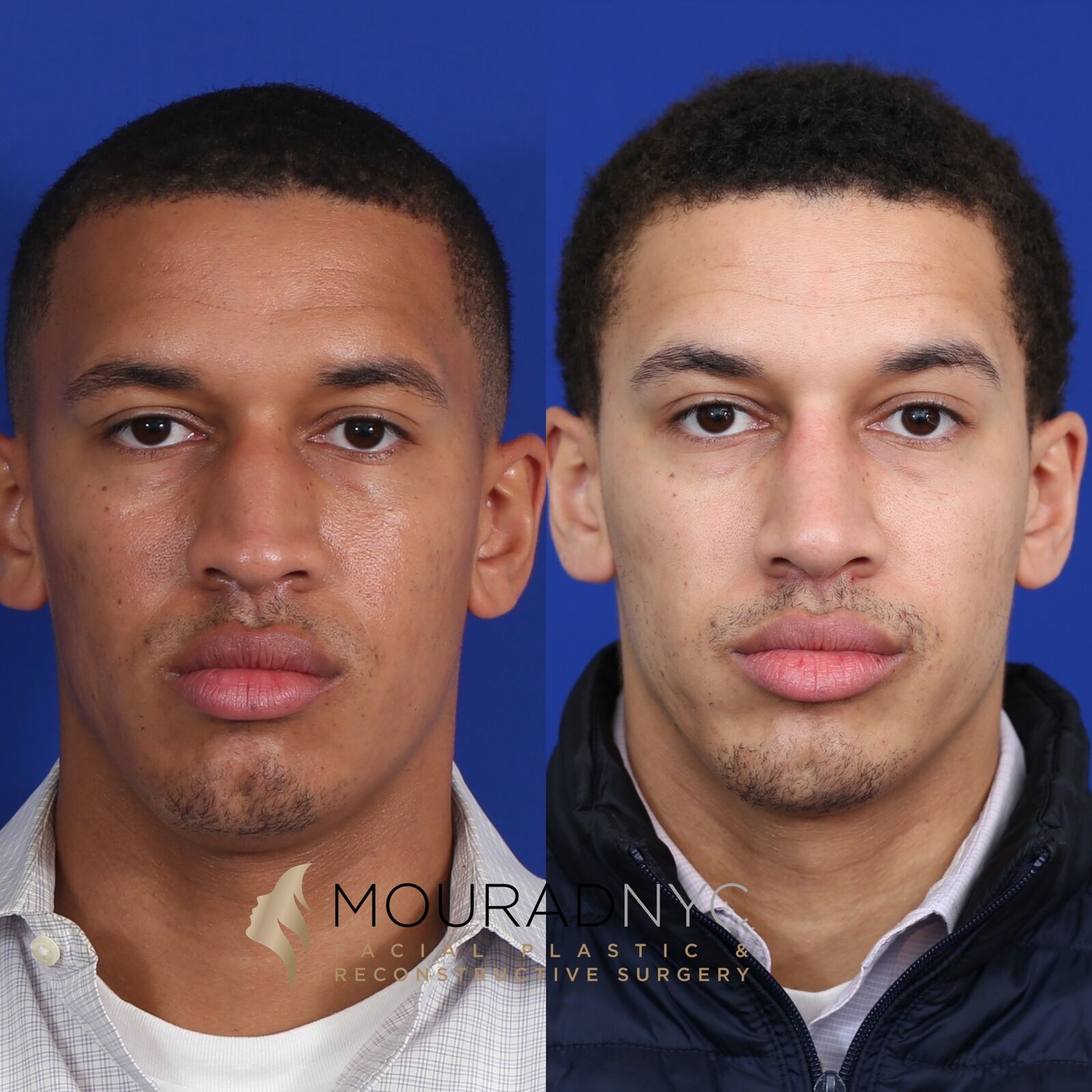 Frontal view comparison of male patient in his 30s before and after ethnic rhinoplasty with rib graft