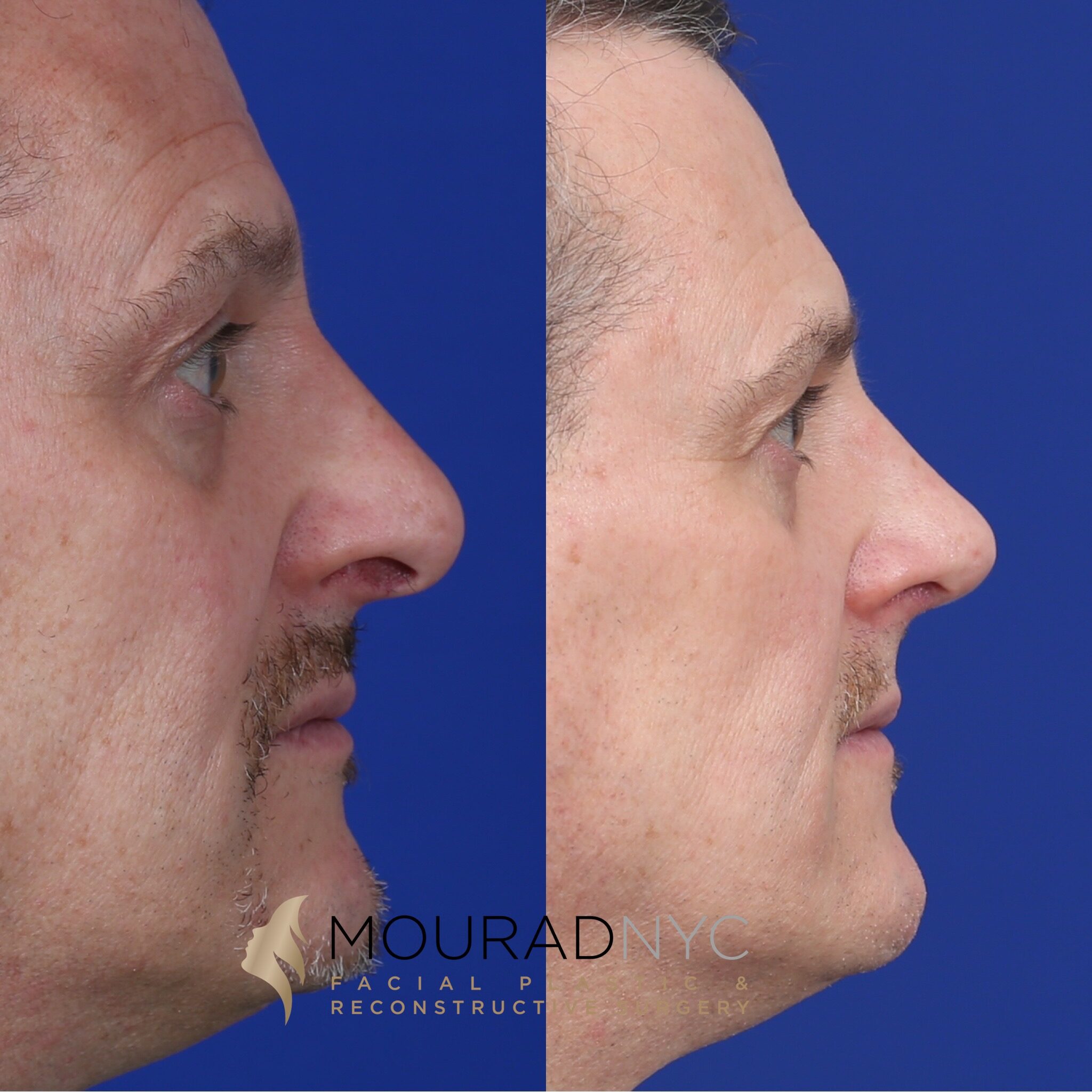 Right lateral profile comparison of male patient in his 50s before and after septorhinoplasty with rib graft, septoplasty, and sinus surgery