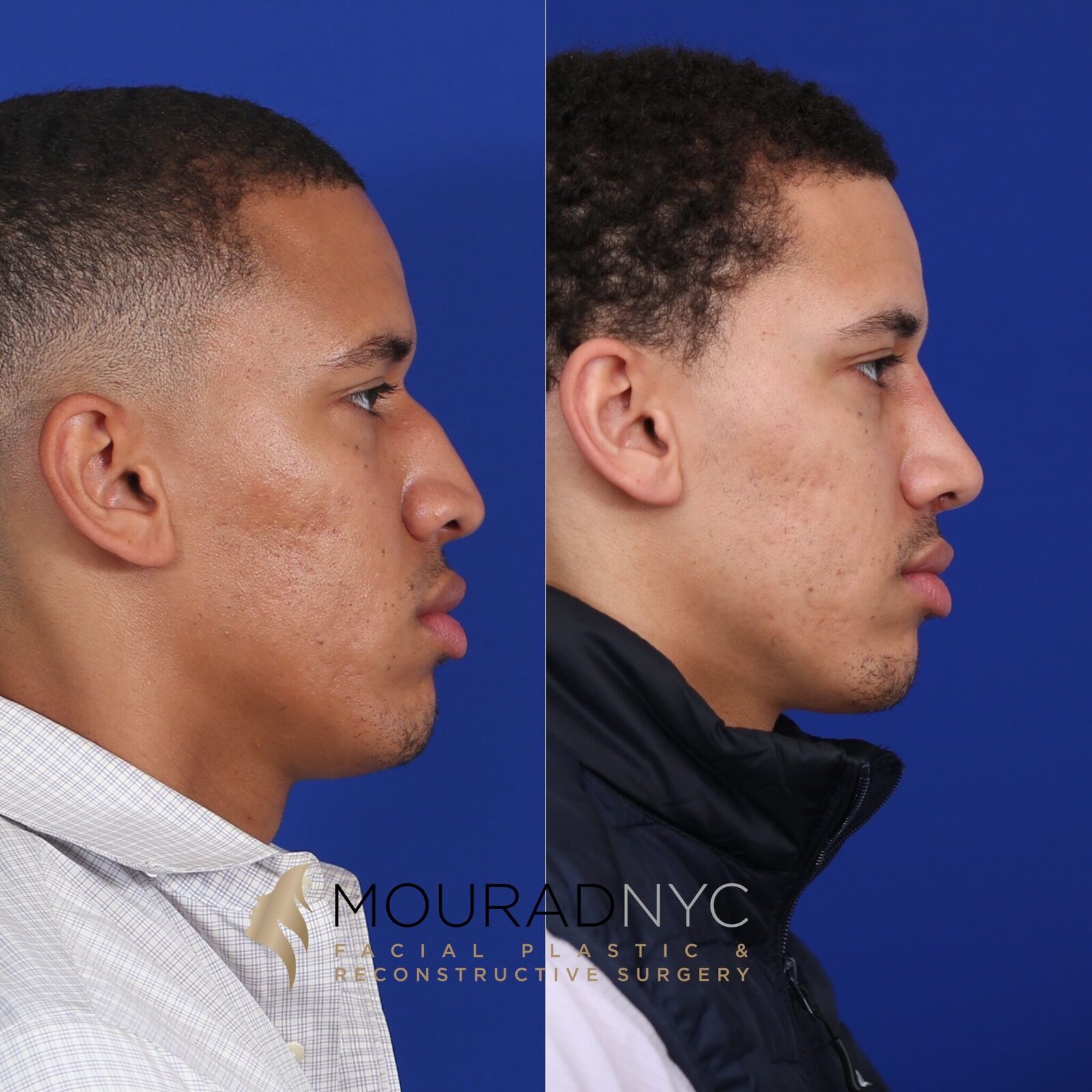 Right lateral profile comparison of male patient before and after ethnic rhinoplasty with rib graft