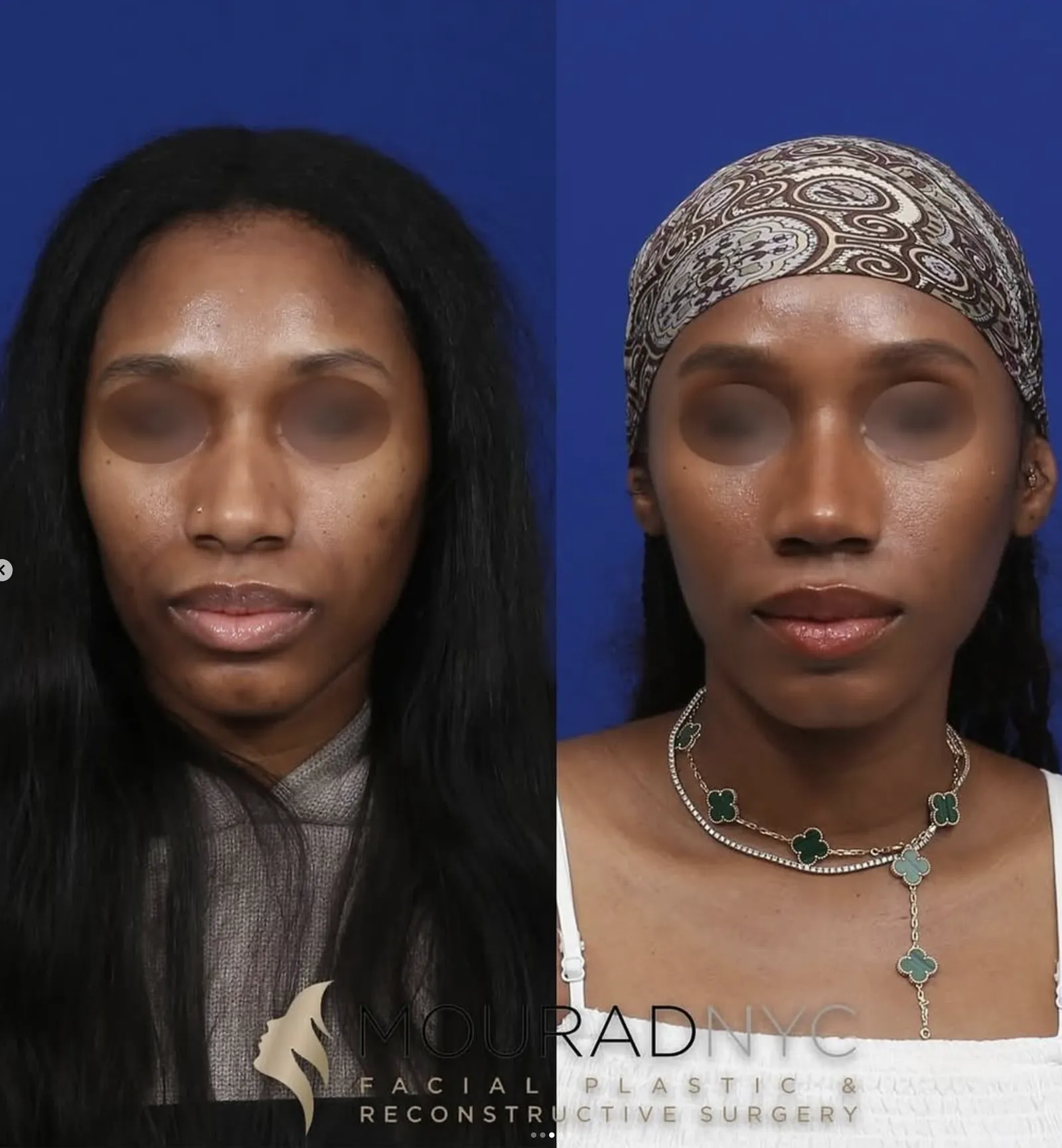 Frontal comparison of a female patient in her 30s before and after ethnic rhinoplasty, sinus surgery, and broken nose repair