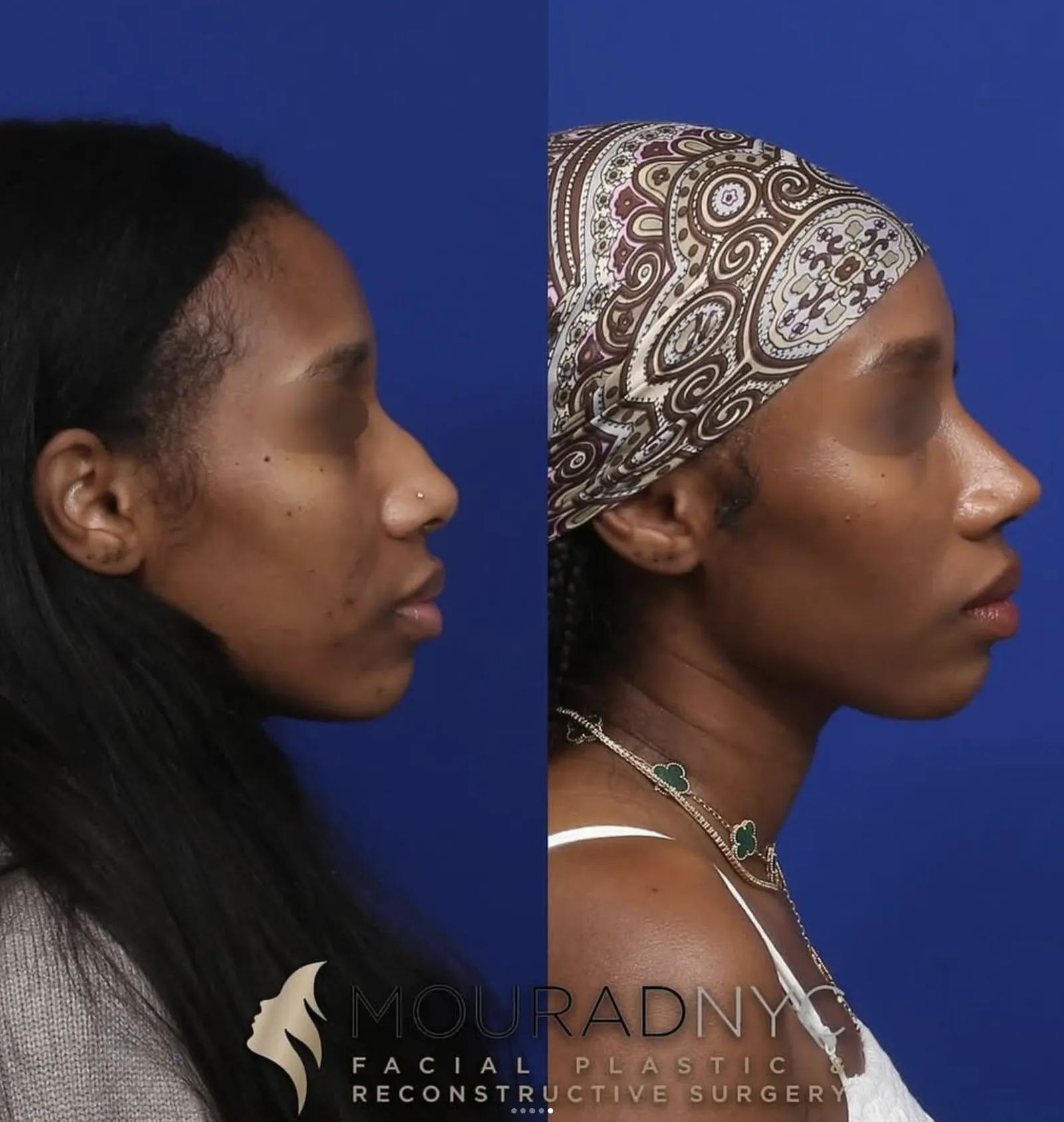 Left lateral profile comparison of a female patient in her 30s before and after ethnic rhinoplasty, sinus surgery, and broken nose repair