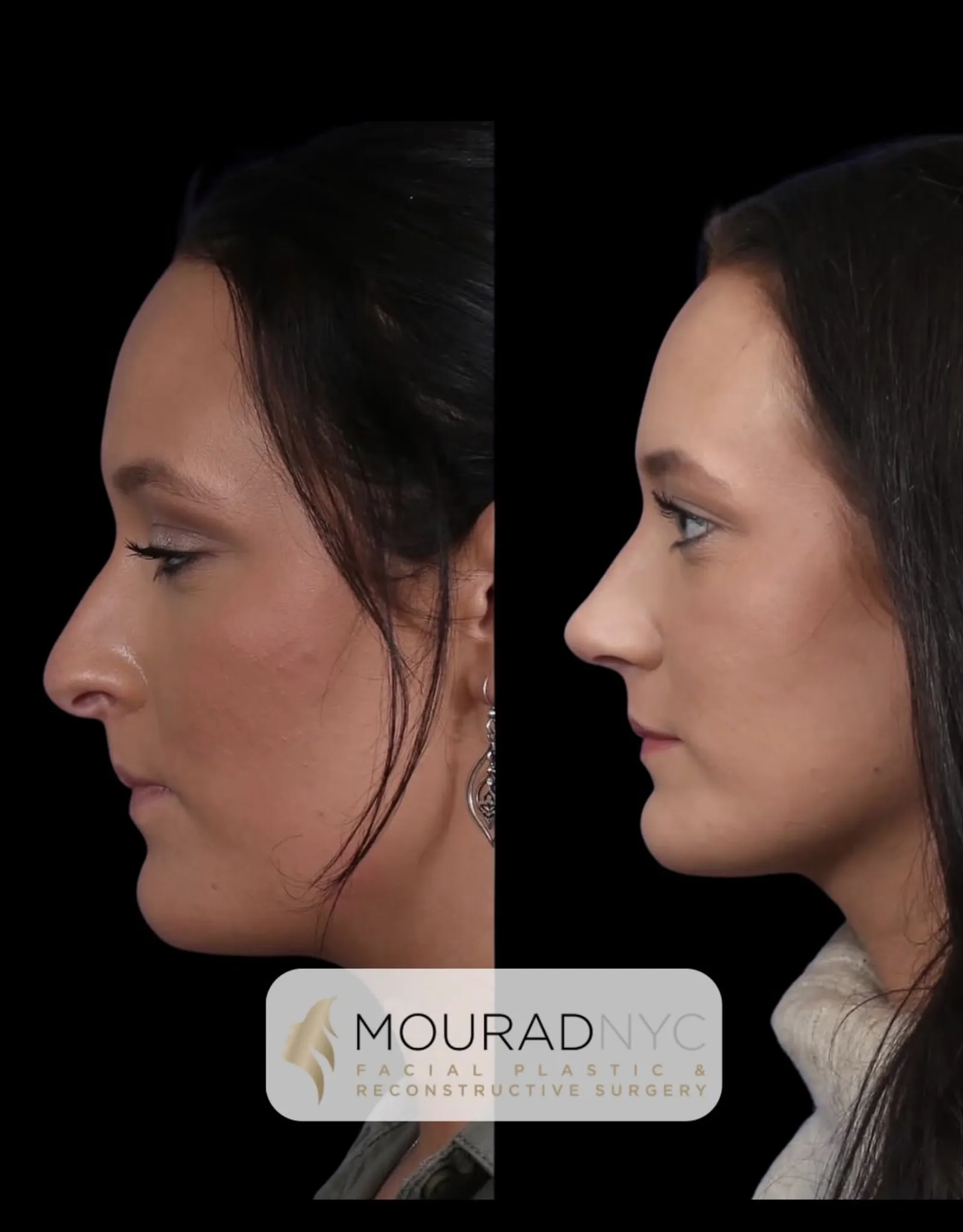 Left lateral profile comparison of a female patient in her 20s before and after revision rhinoplasty with rib graft
