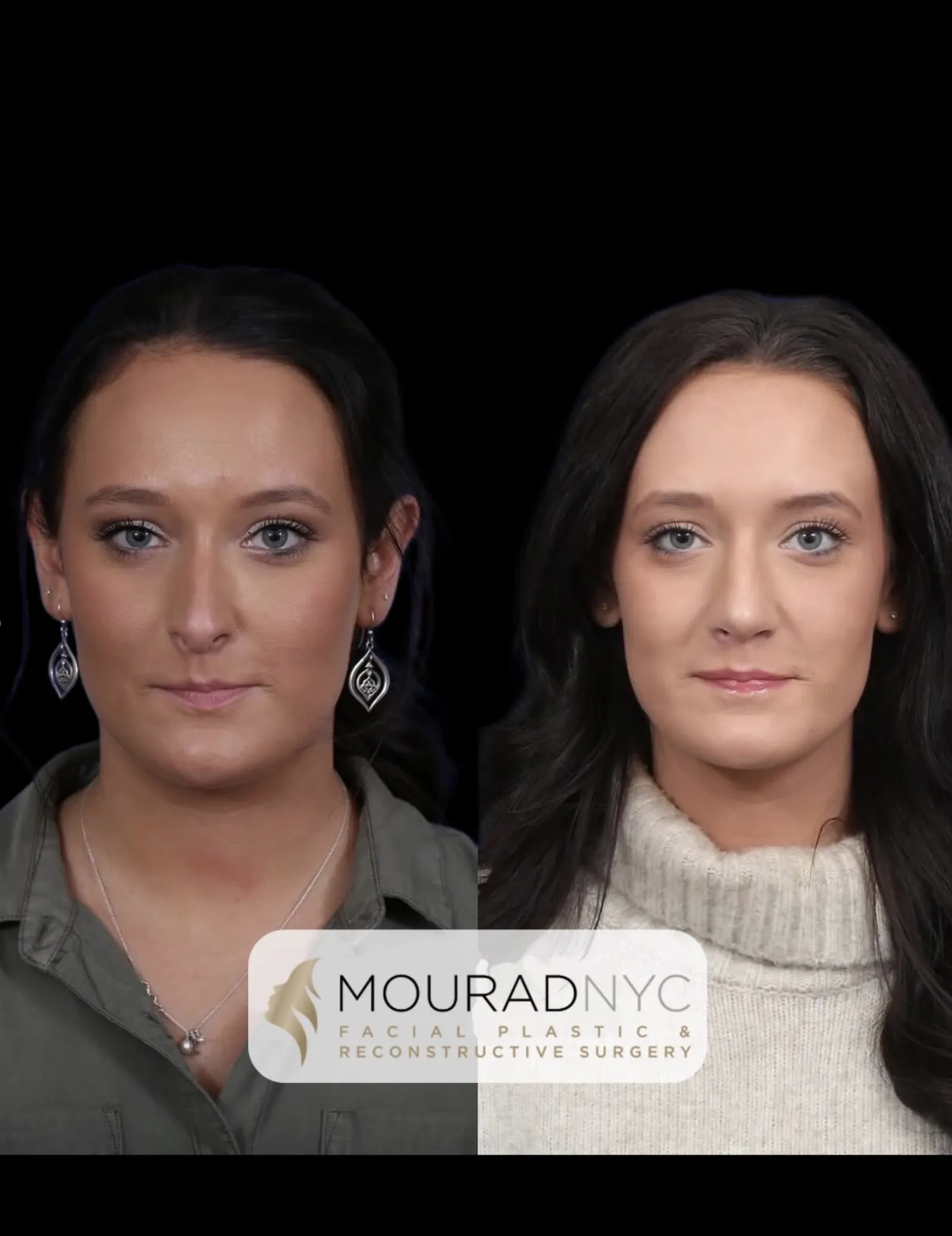 Frontal comparison of a female patient in her 20s before and after revision rhinoplasty with rib graft