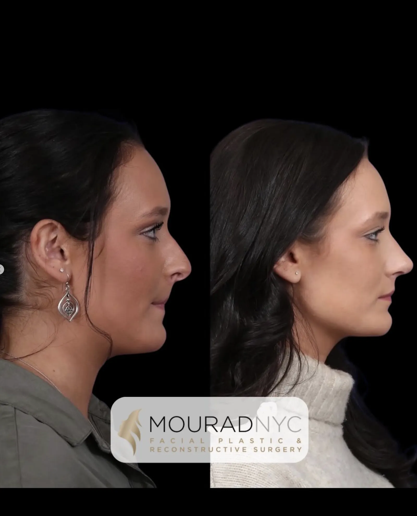 Right lateral profile comparison of a female patient in her 20s before and after revision rhinoplasty with rib graft