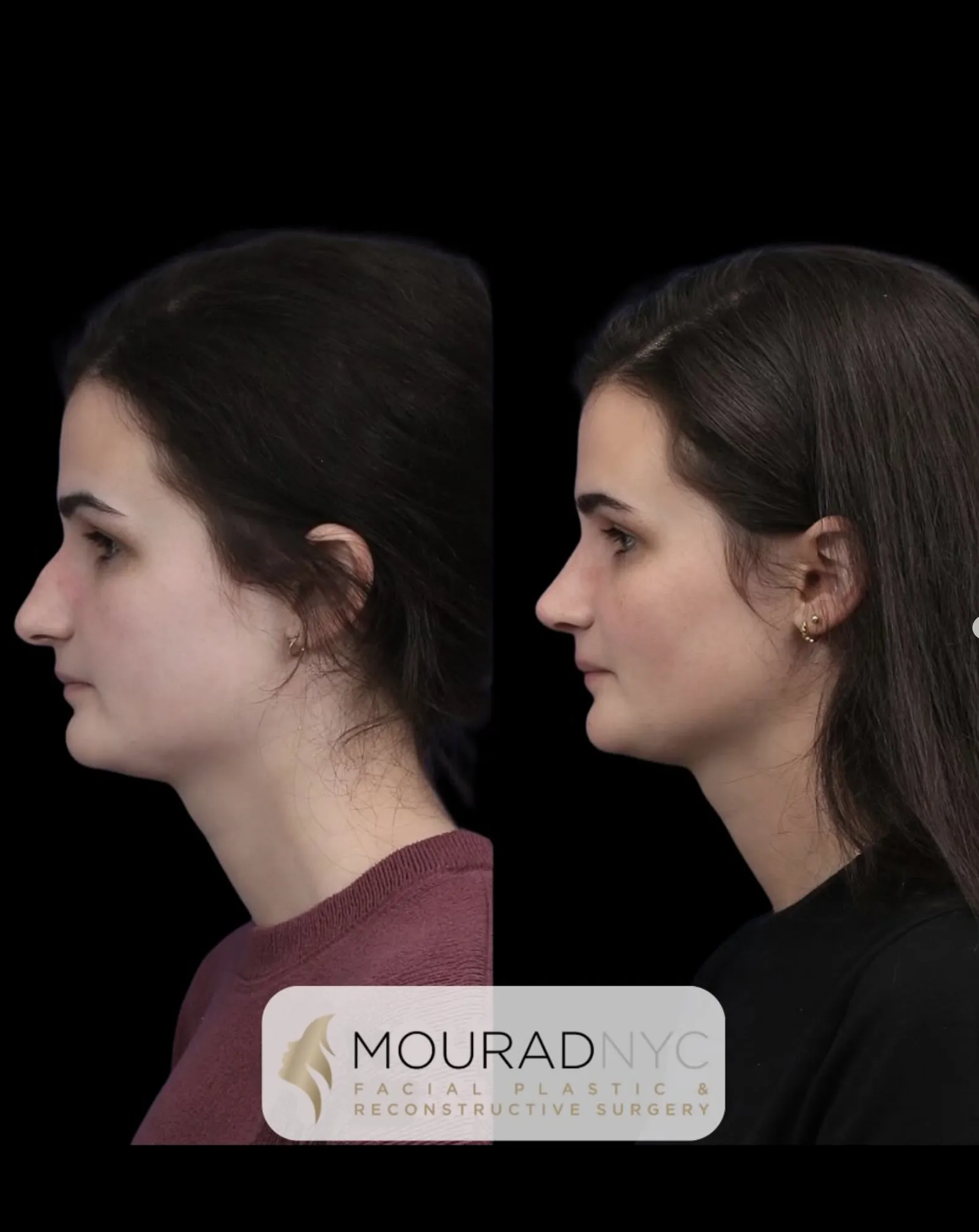 Right lateral profile comparison of a female patient in her 20s before and after primary rhinoplasty with broken nose repair
