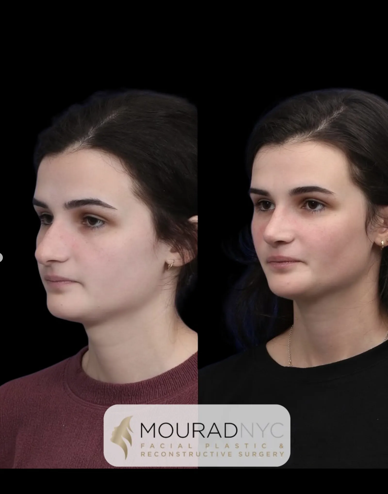 Left oblique comparison of a female patient in her 20s before and after primary rhinoplasty with broken nose repair