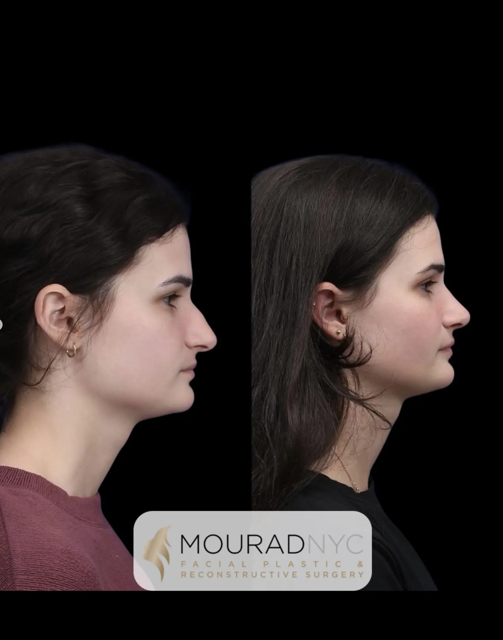 Left lateral profile comparison of a female patient in her 20s before and after primary rhinoplasty with broken nose repair