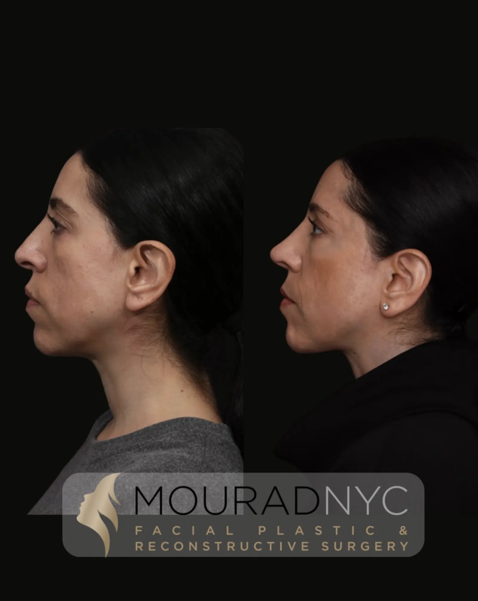 Right lateral profile comparison of a female patient in her 30s before and after revision rhinoplasty with rib graft