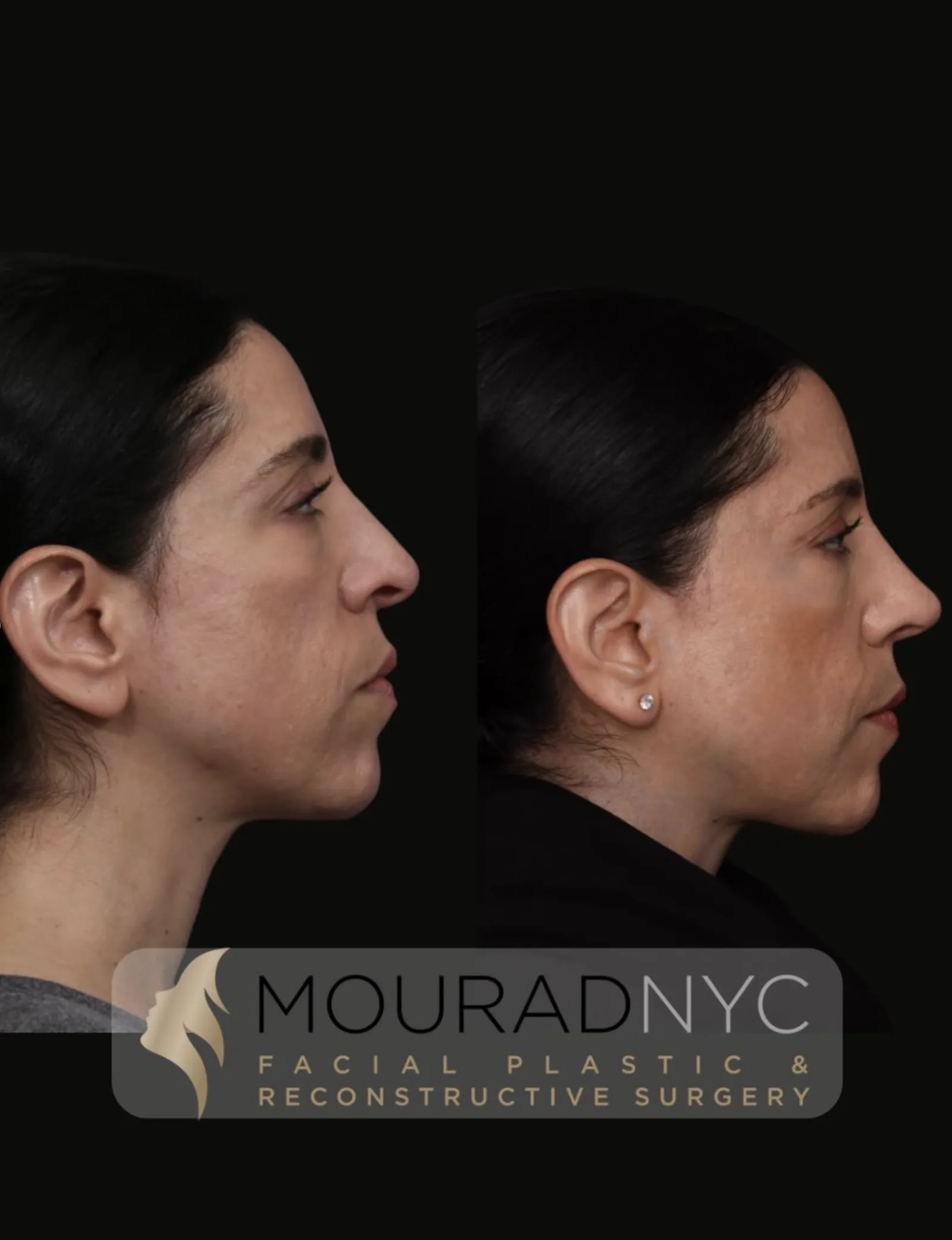 Left lateral profile comparison of a female patient in her 30s before and after revision rhinoplasty with rib graft