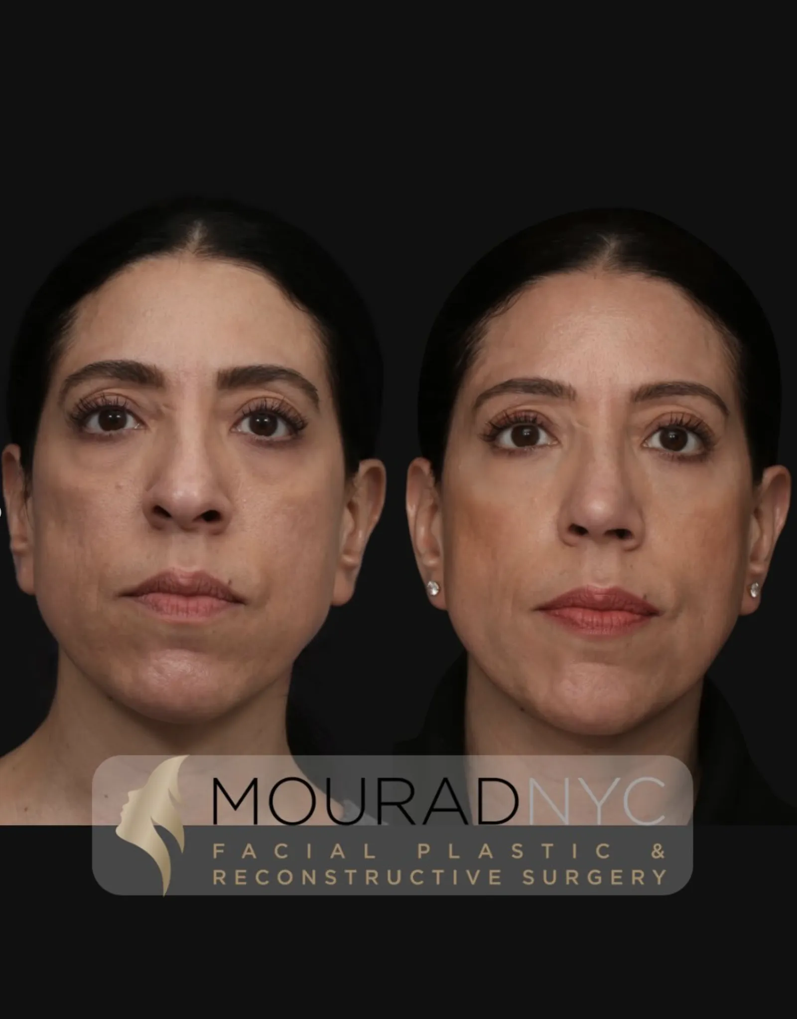 Frontal comparison of a female patient in her 30s before and after revision rhinoplasty with rib graft