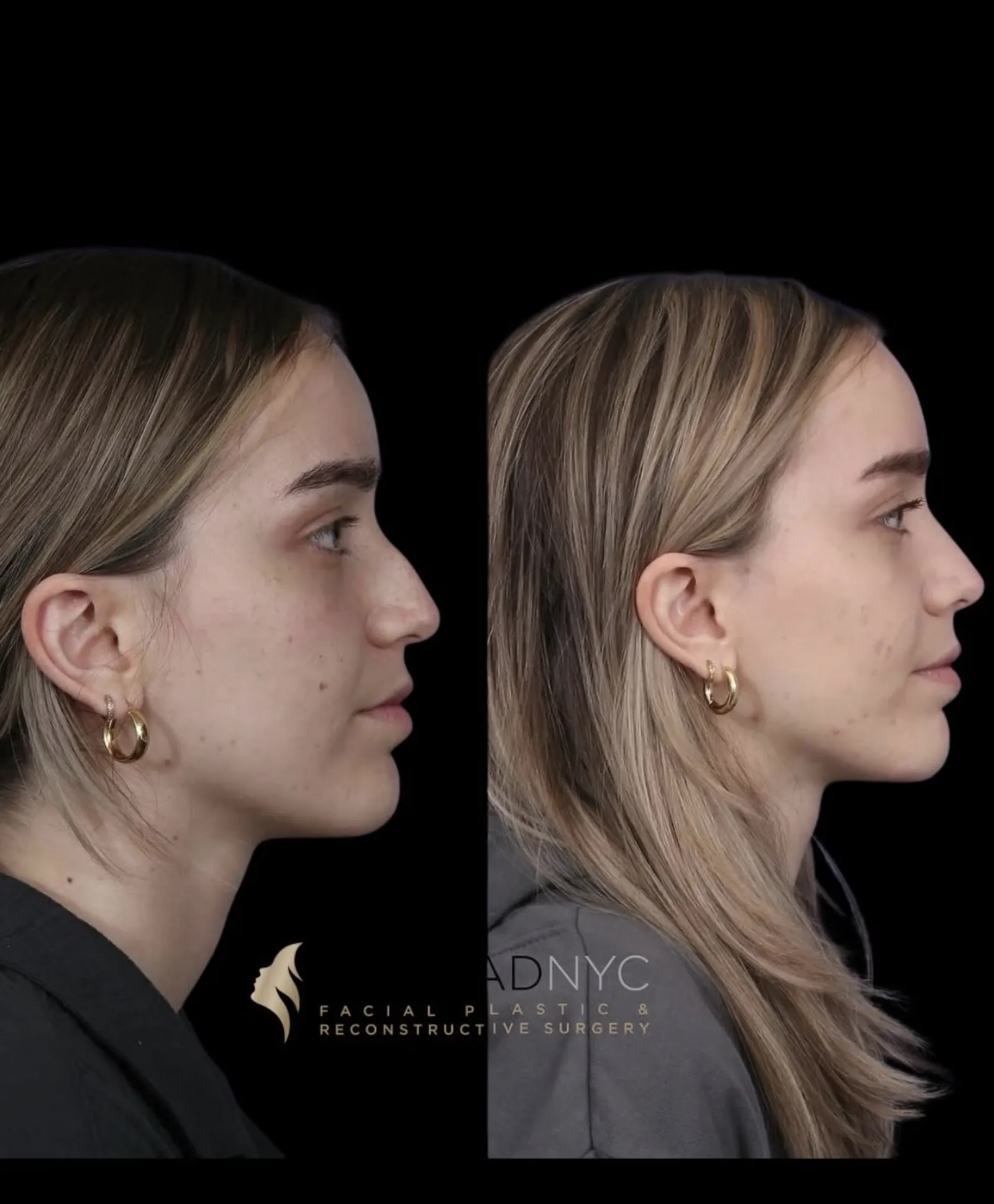 Left lateral profile comparison of a female patient in her 20s before and after primary rhinoplasty