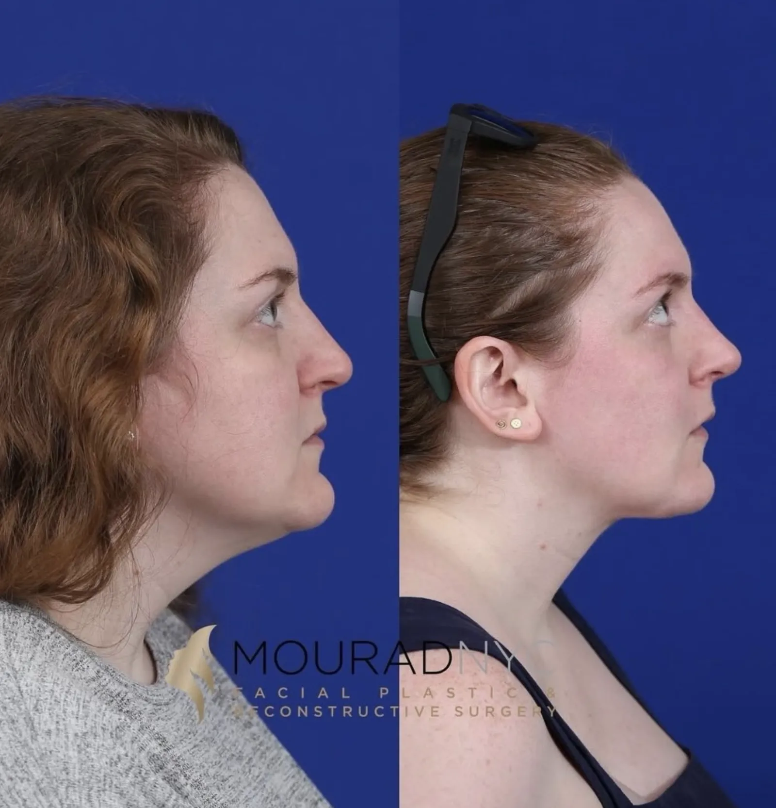Lateral profile comparison of a female patient in her 30s before and after primary rhinoplasty and neck lift