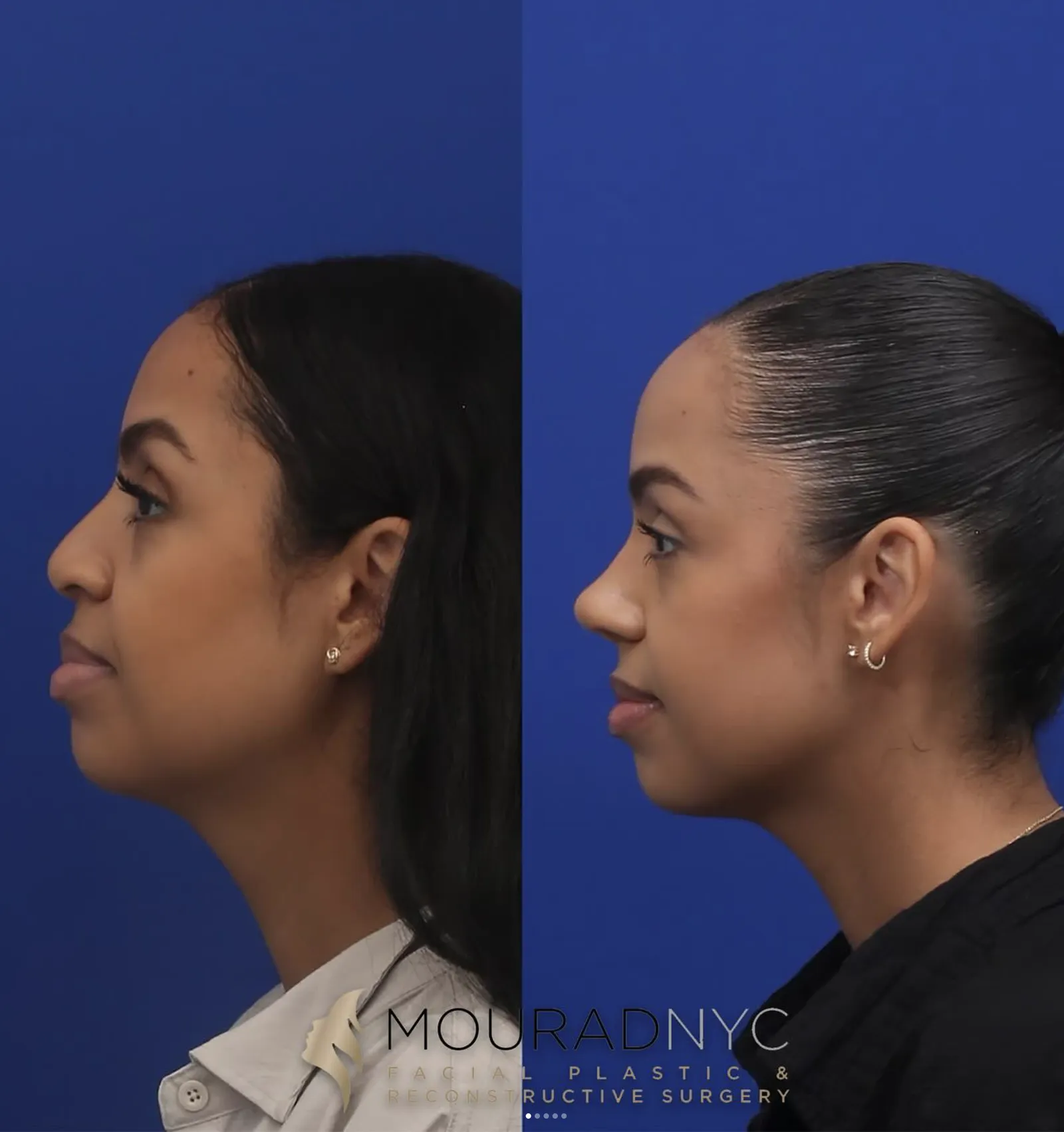 Right lateral profile comparison of a female patient in her 30s before and after revision rhinoplasty with rib graft