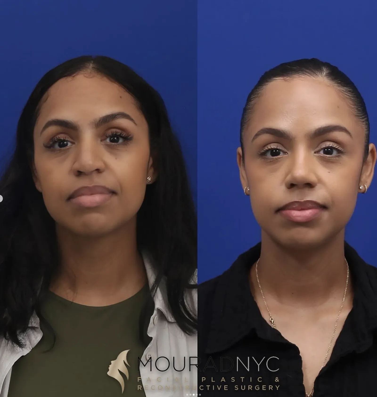 Frontal comparison of a female patient in her 30s before and after revision rhinoplasty with rib graft