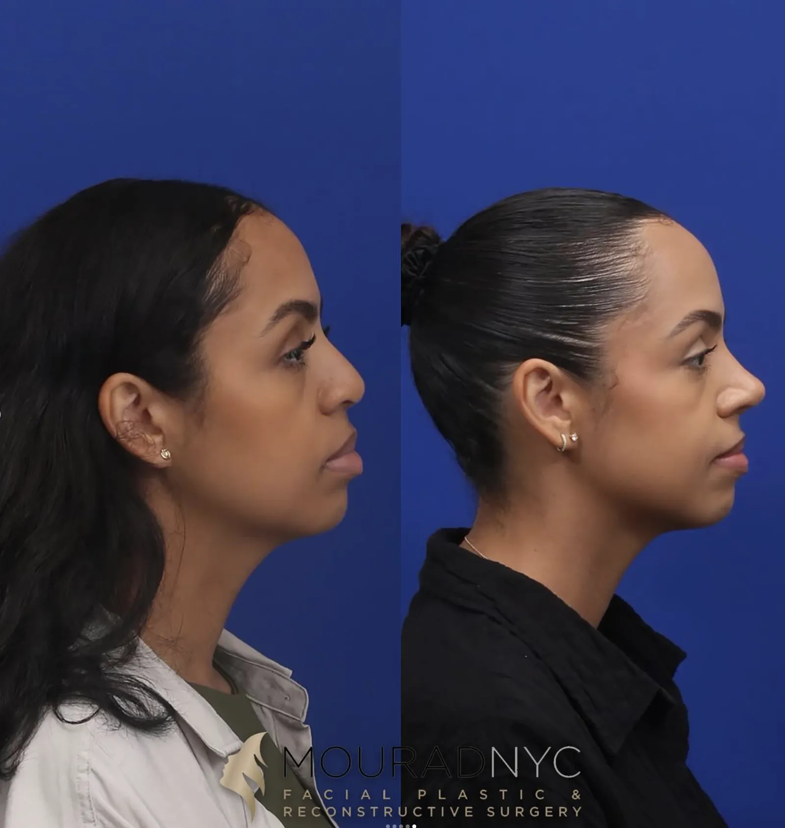 Left lateral profile comparison of a female patient in her 30s before and after revision rhinoplasty with rib graft